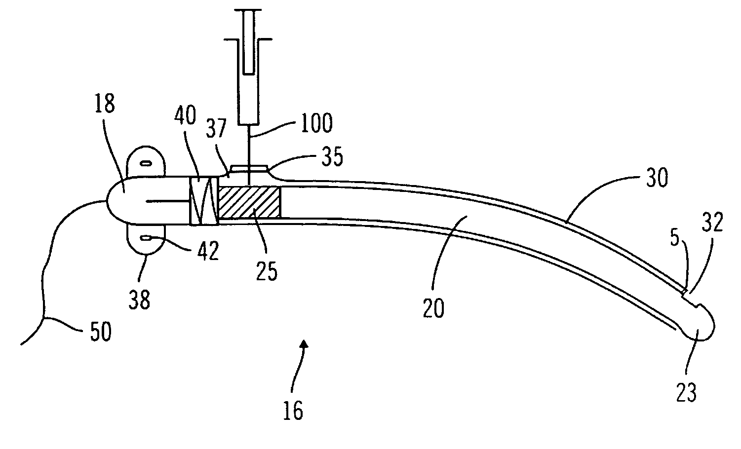 Implantable sensor flush sleeve