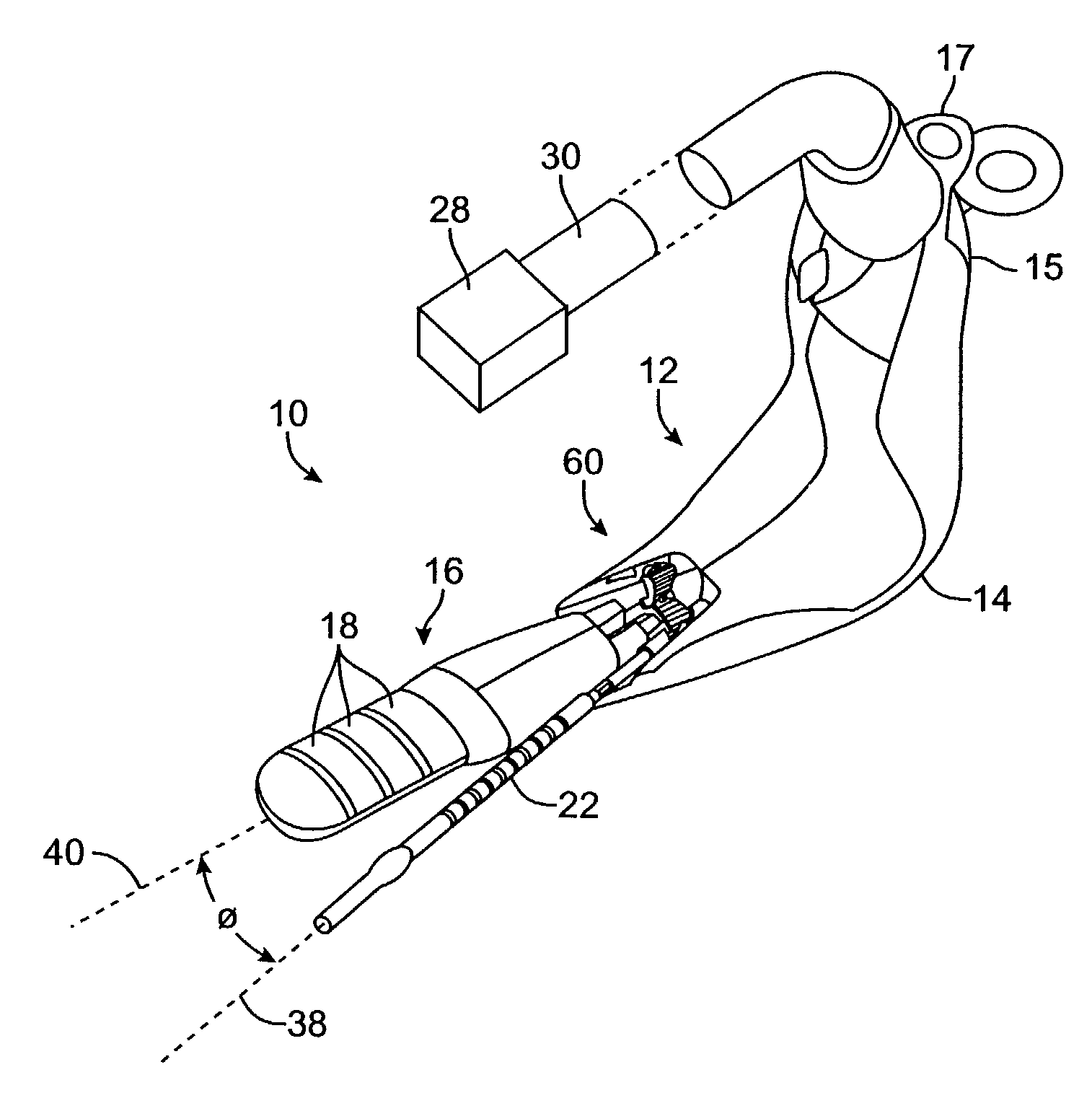 Incontinence treatment with urethral guide