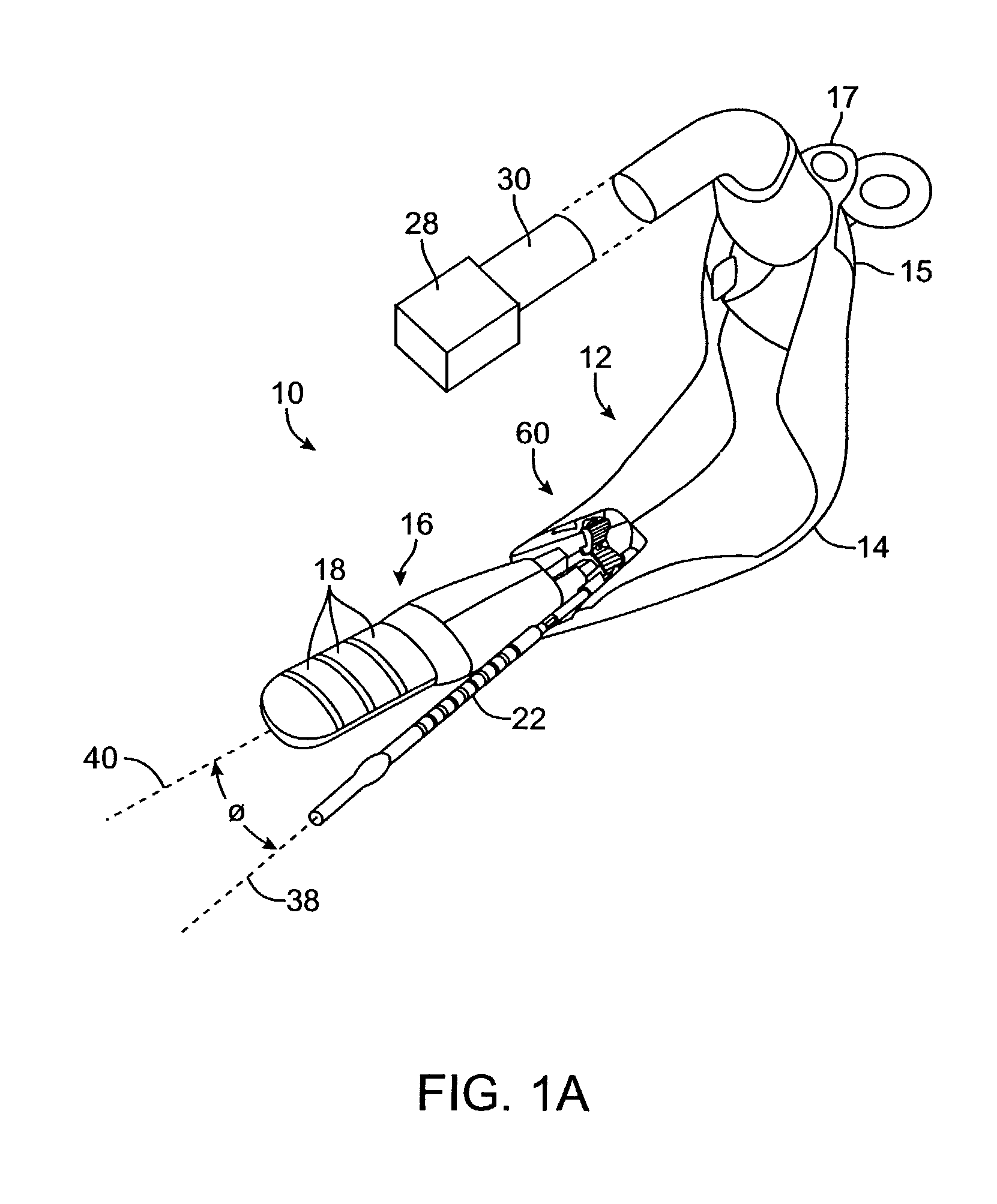 Incontinence treatment with urethral guide