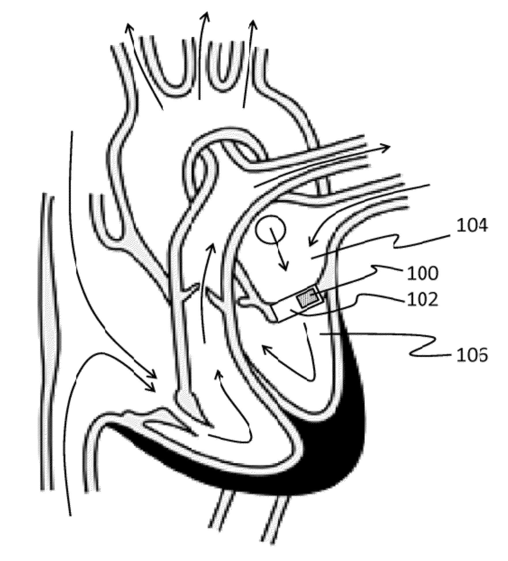 Wireless hemodynamic monitoring system integrated with implantable heart valves