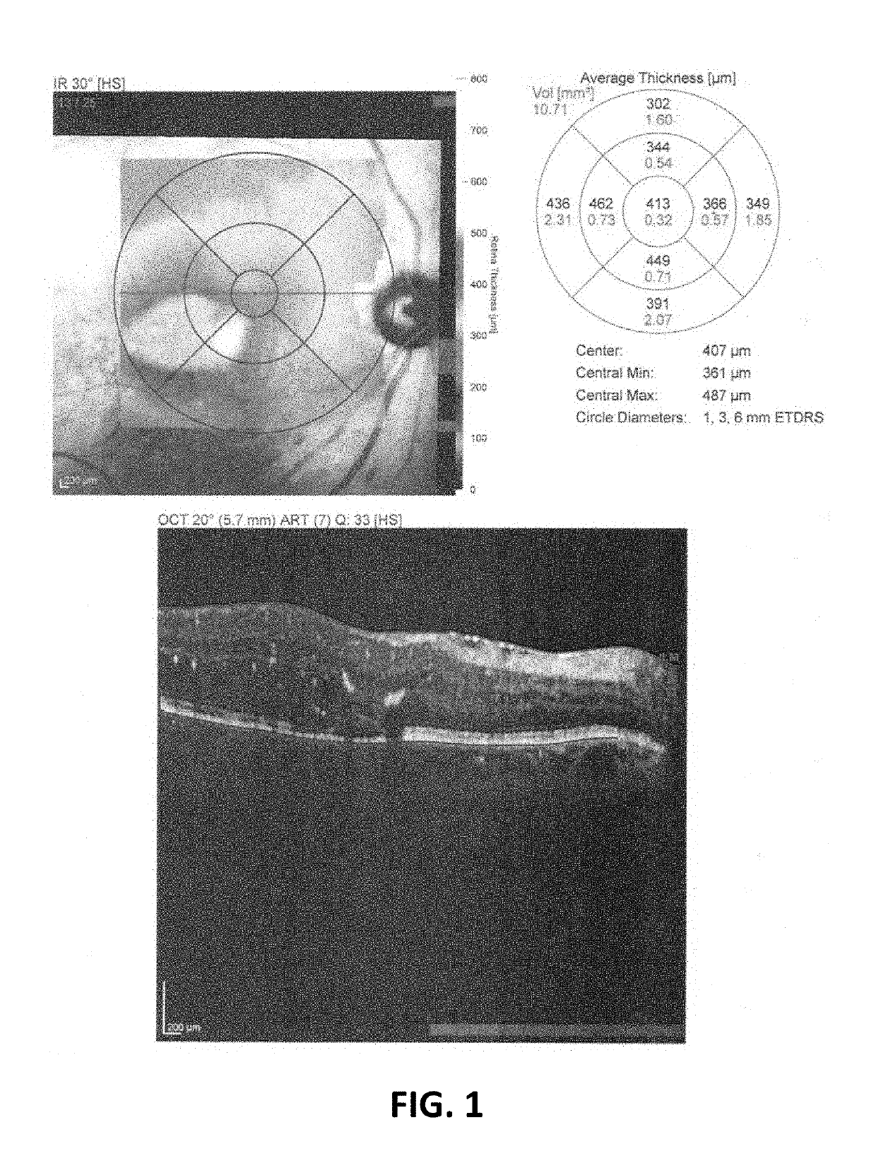 Salbutamol-containing ophthalmic medicament