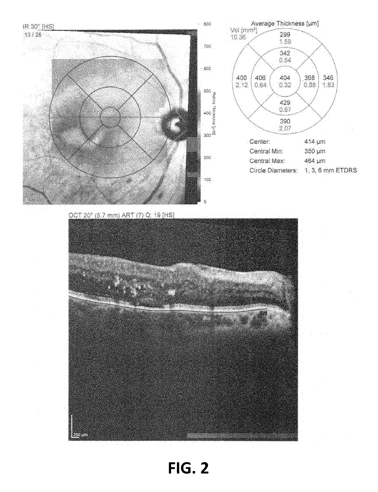 Salbutamol-containing ophthalmic medicament