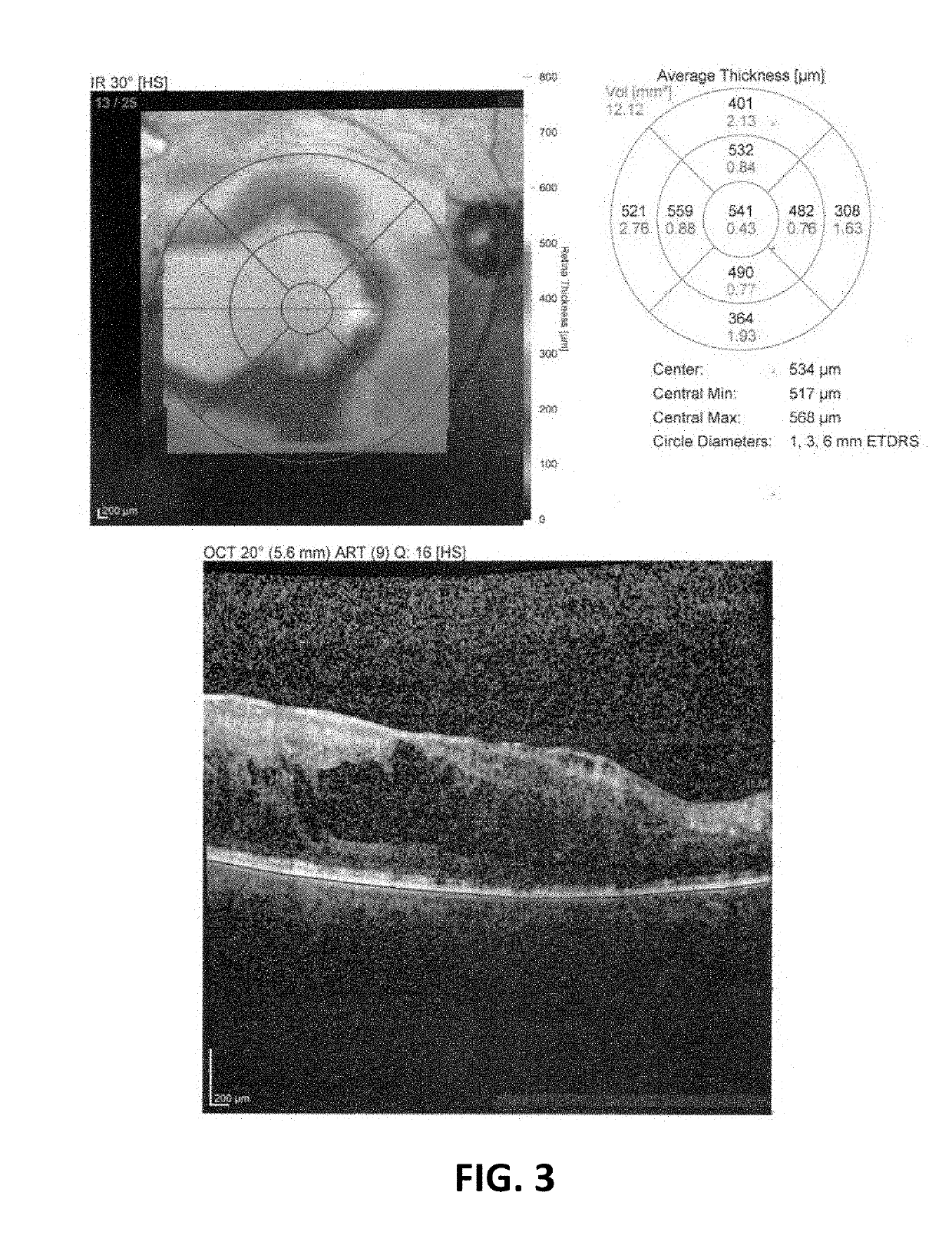 Salbutamol-containing ophthalmic medicament