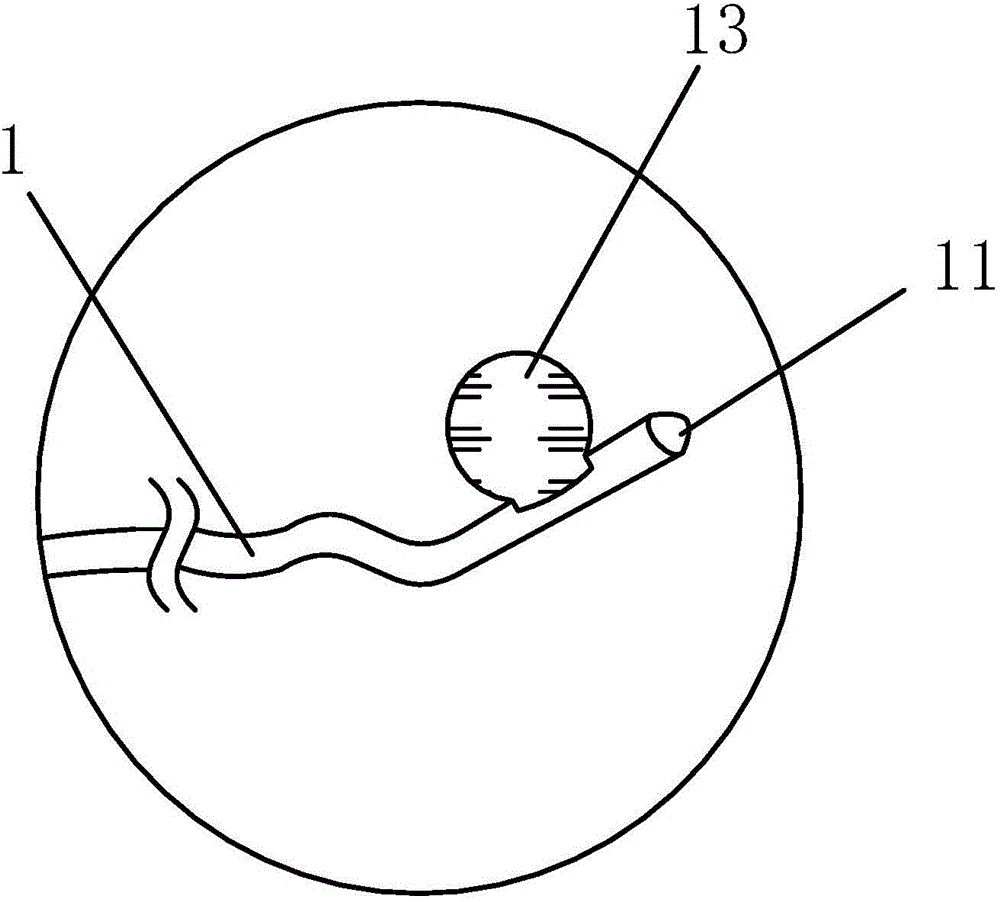 Novel blocking type calculus removing catheter