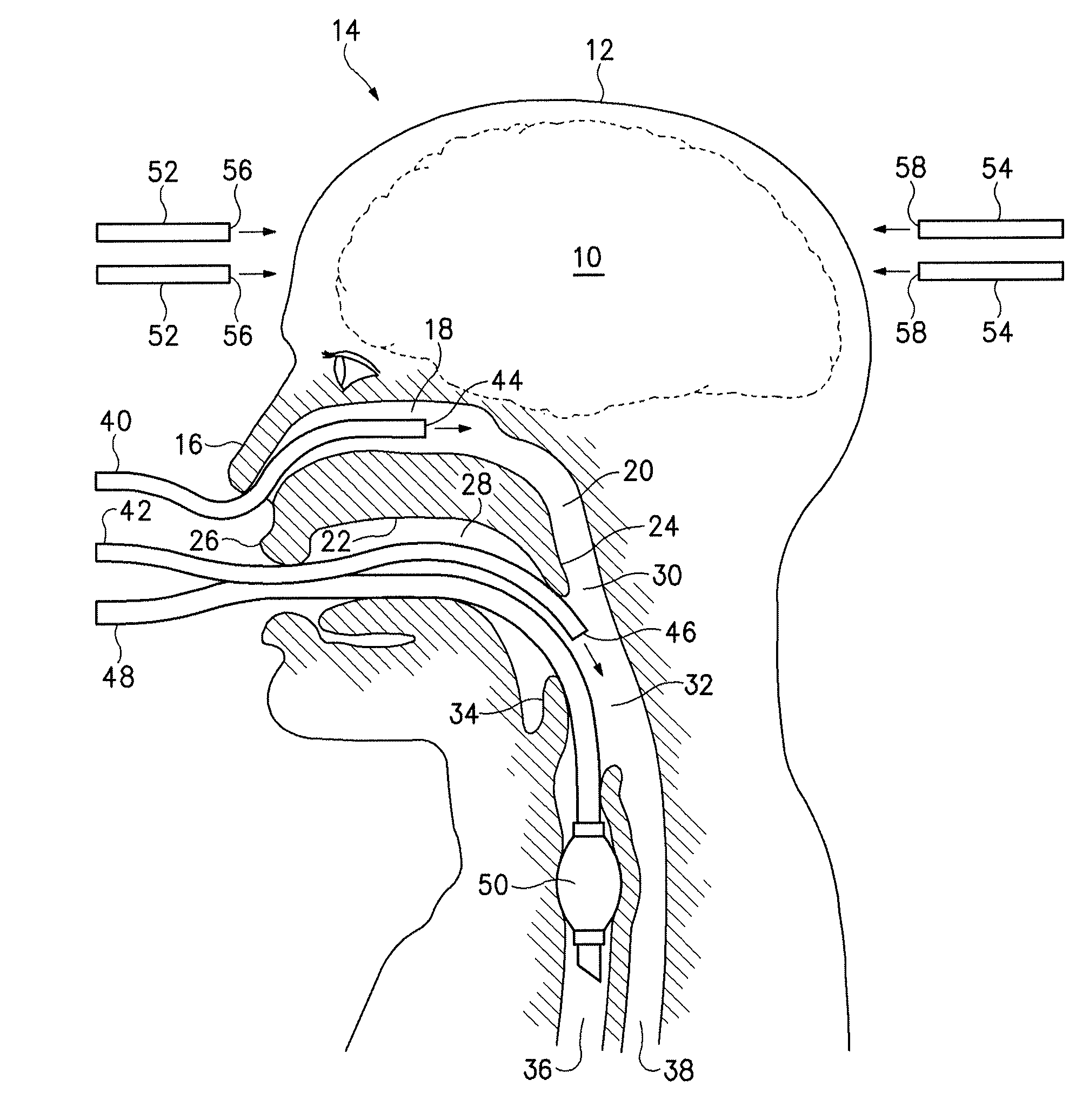 Non-invasive systems, devices, and methods for selective brain cooling