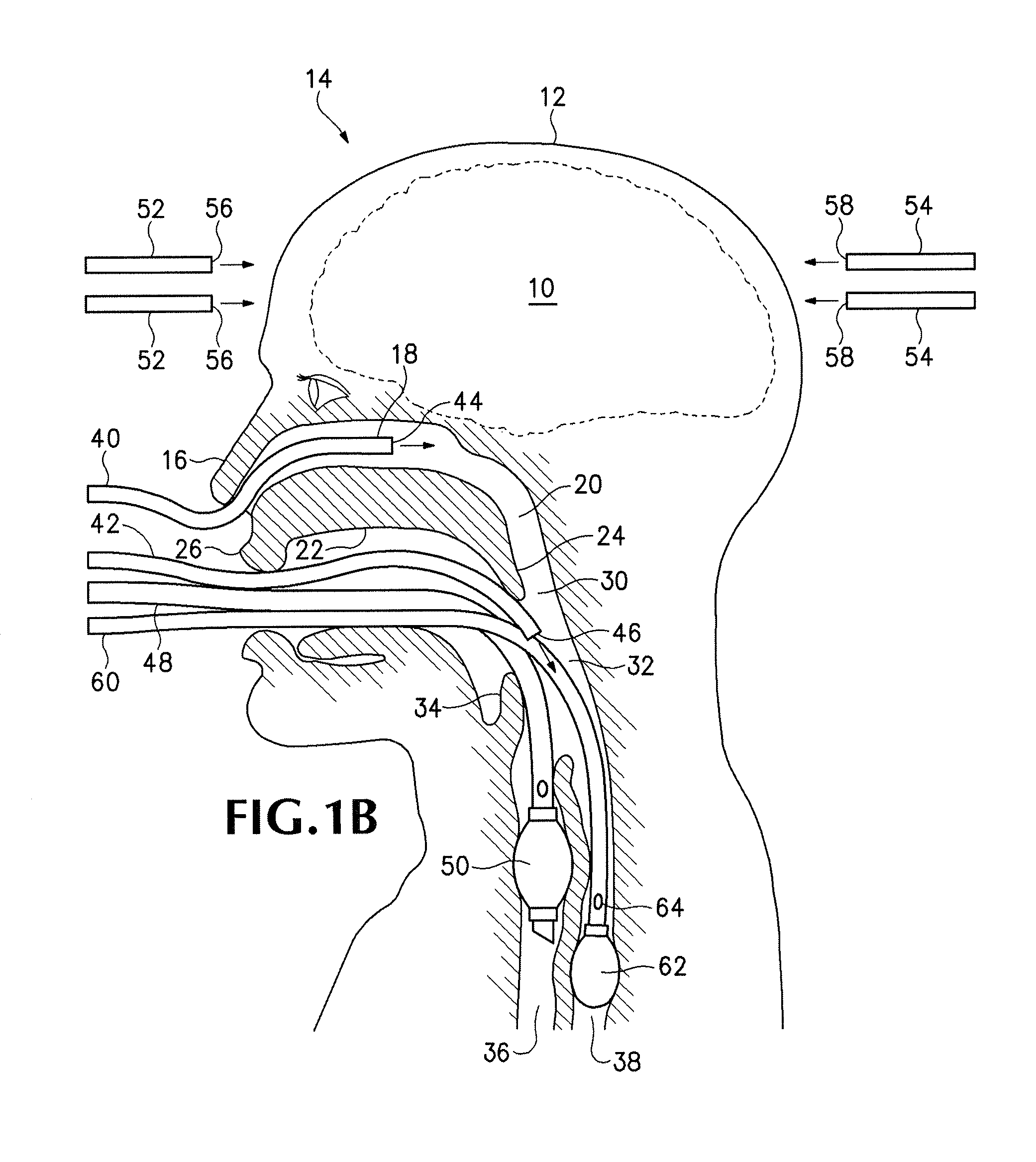 Non-invasive systems, devices, and methods for selective brain cooling