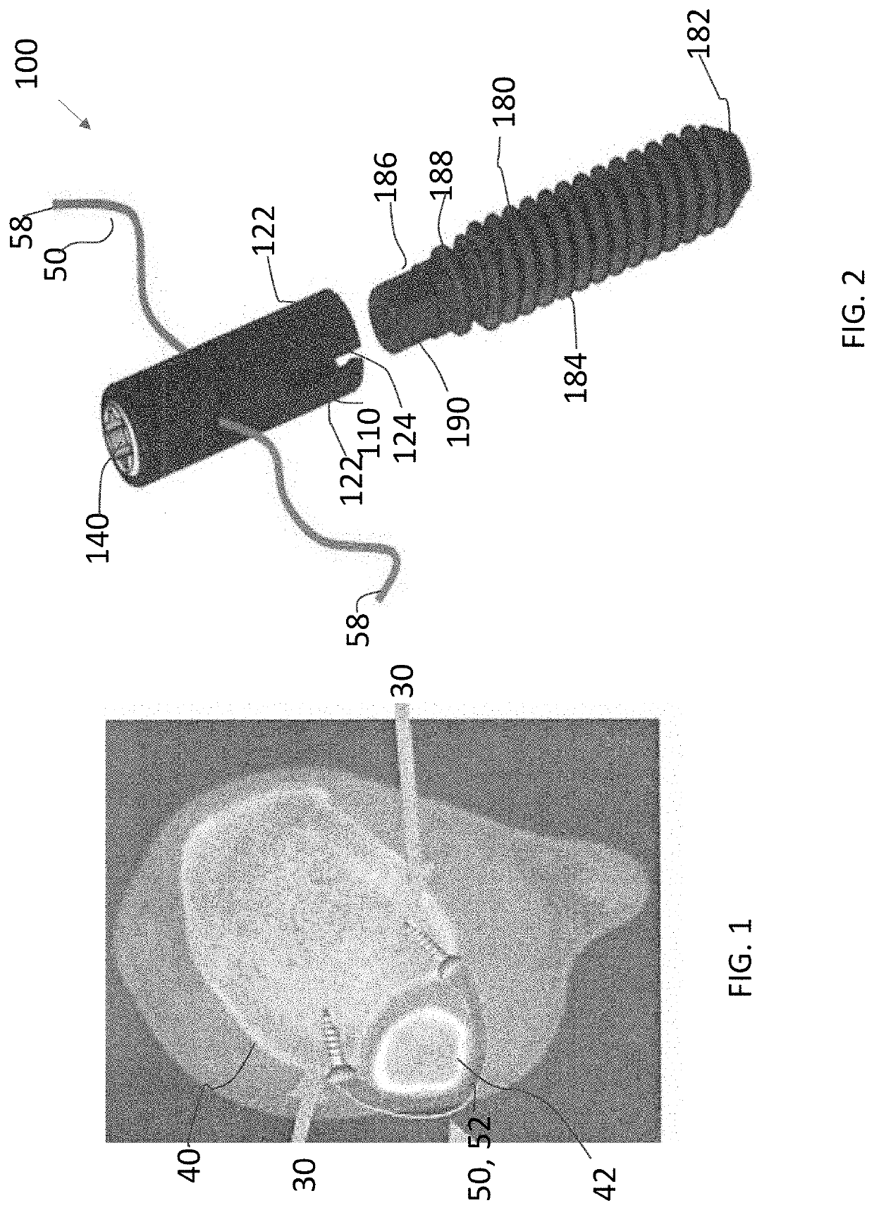 Syndesmosis Fixation Assembly