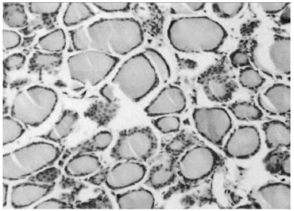 Use of pyrazolopyrimidine derivatives in the treatment of autoimmune thyroid disease