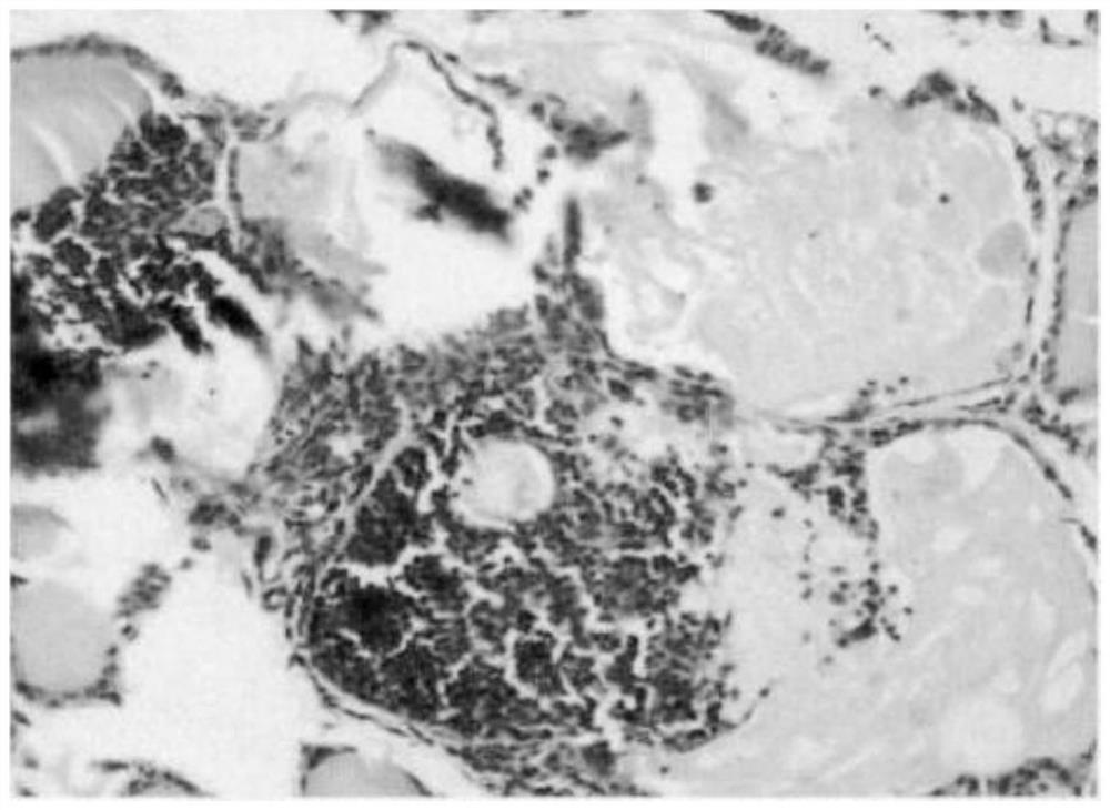 Use of pyrazolopyrimidine derivatives in the treatment of autoimmune thyroid disease