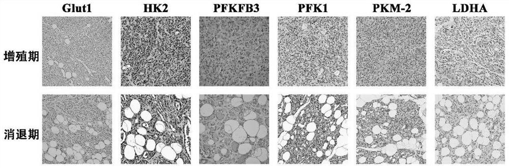 Application of glycolytic pathway key enzyme in infantile hemangioma