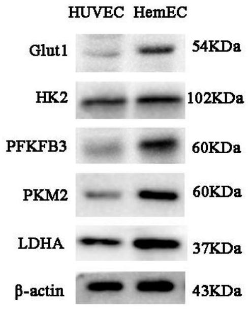 Application of glycolytic pathway key enzyme in infantile hemangioma