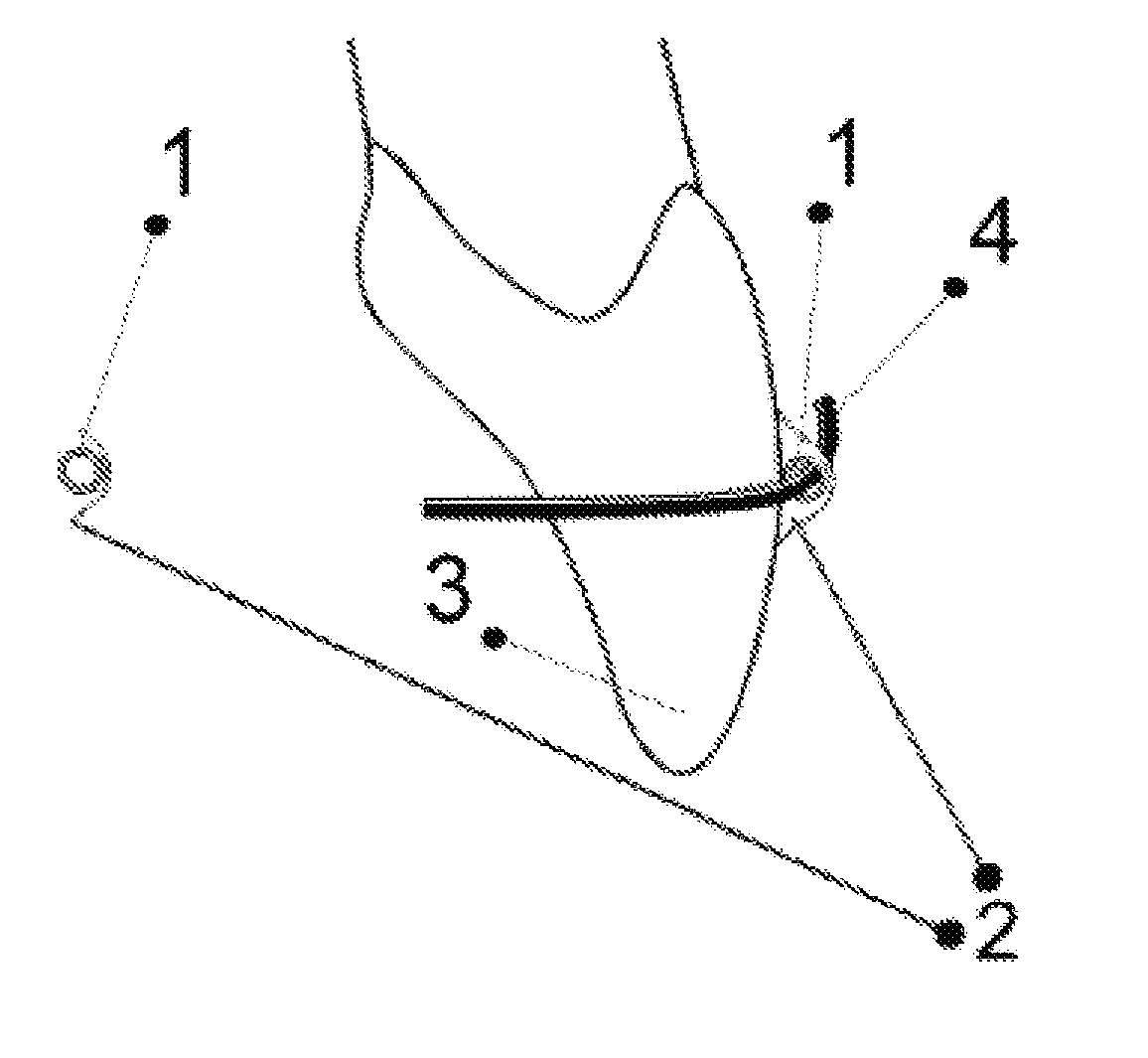 Orthodontic system and method of use