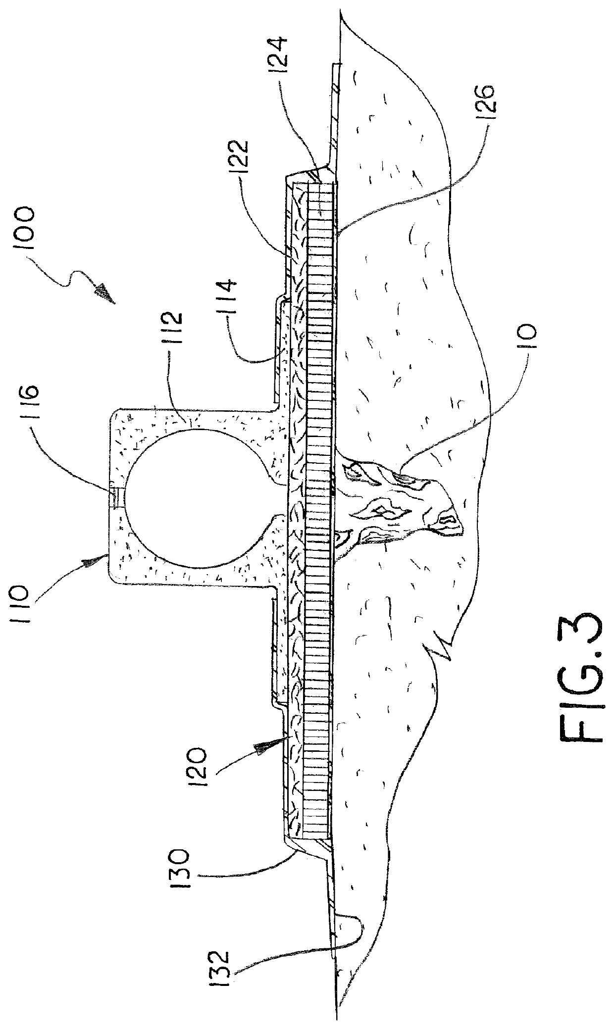 Wound dressing