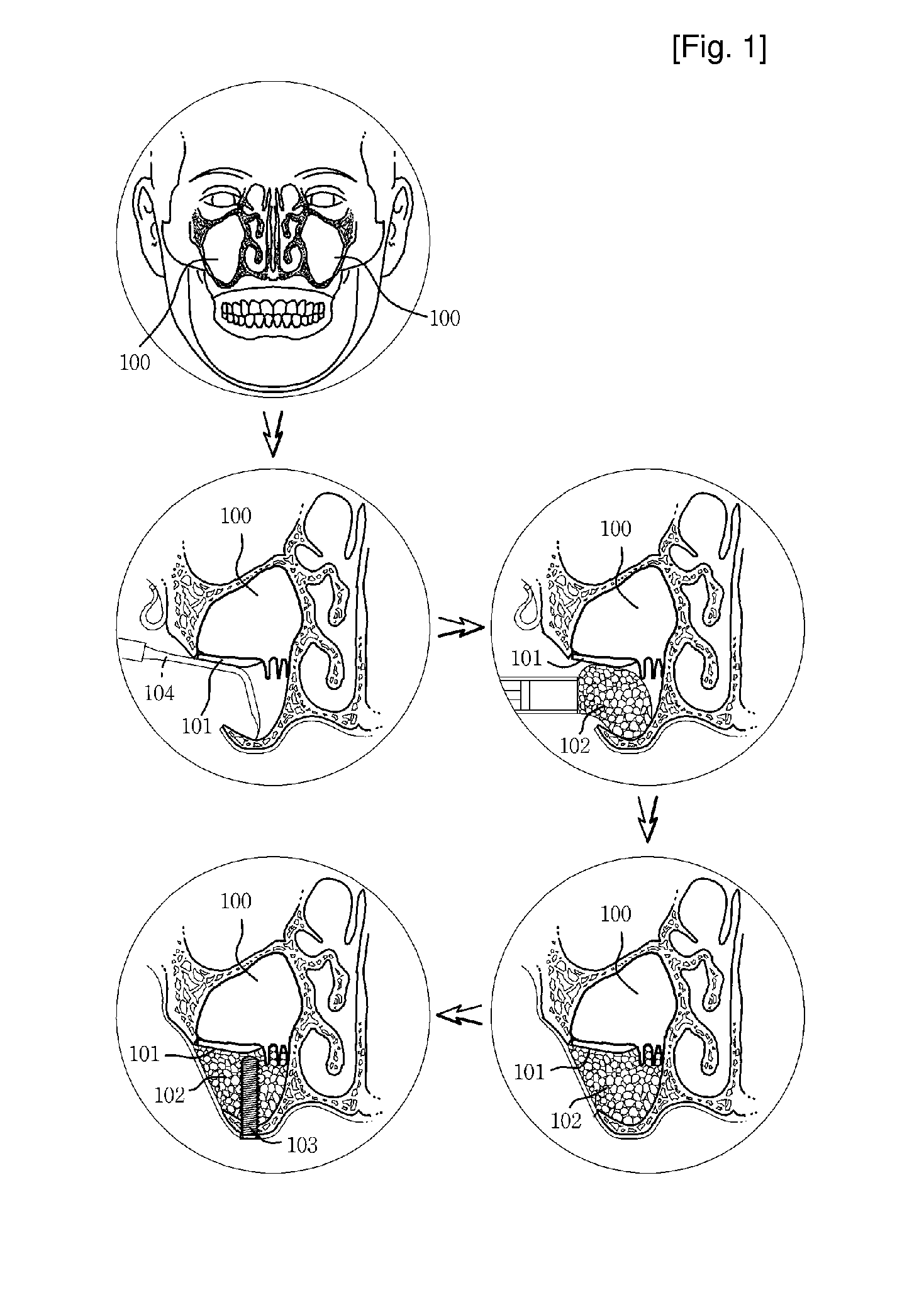 Reamer for Operating Implant