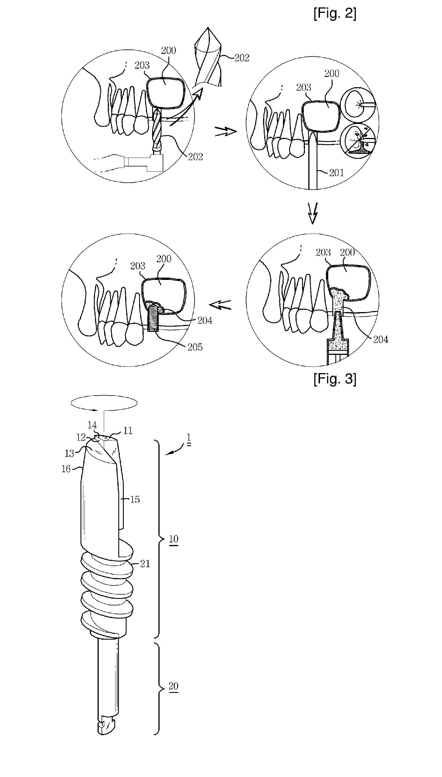 Reamer for Operating Implant