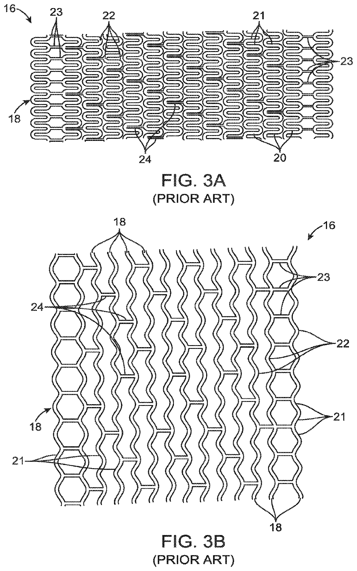 Uncaging stent