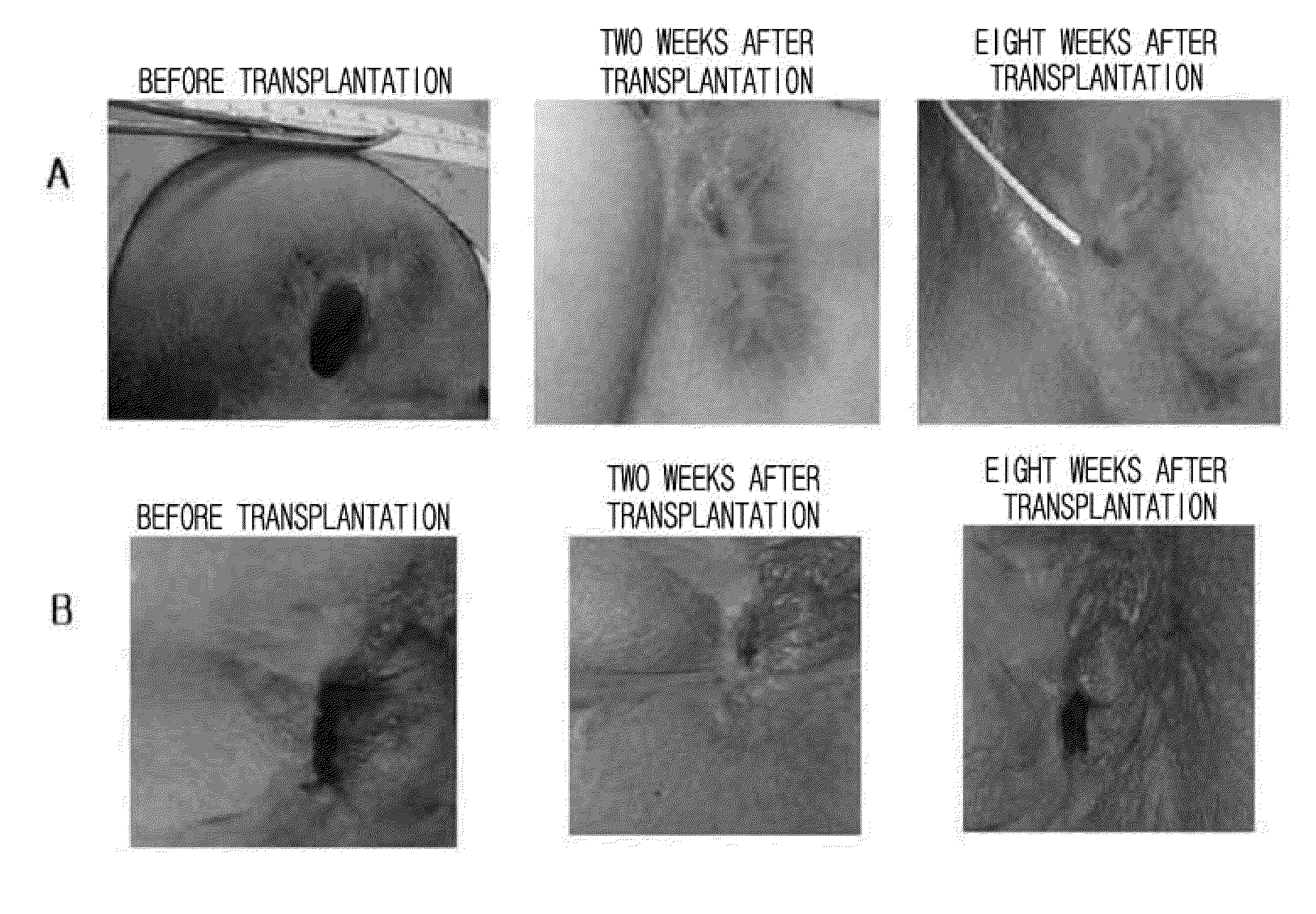 Autologous and allogenic adipose-derived stromal stem cell composition for treating fistulas