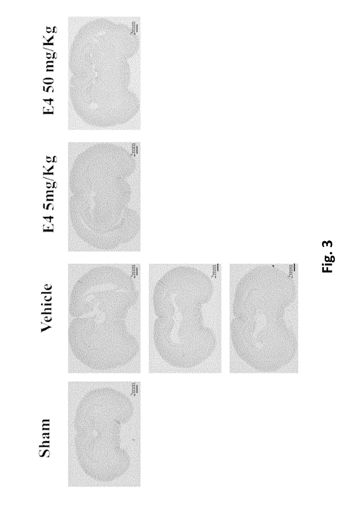 Estrogenic components for use in the treatment of neurological disorders