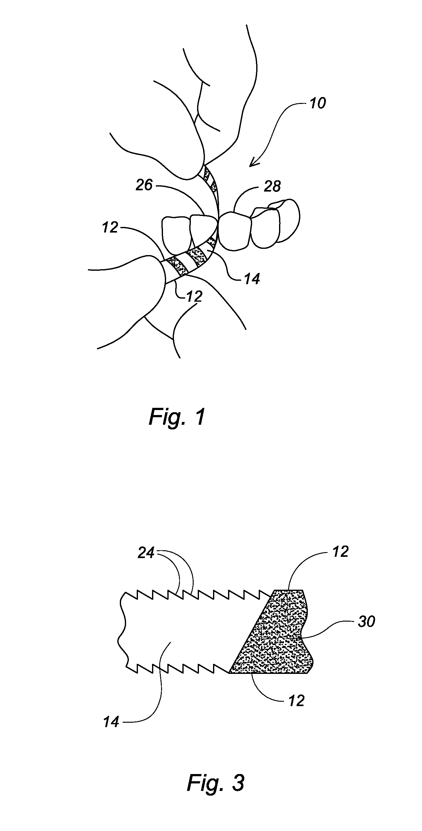 Interproximal dental strip