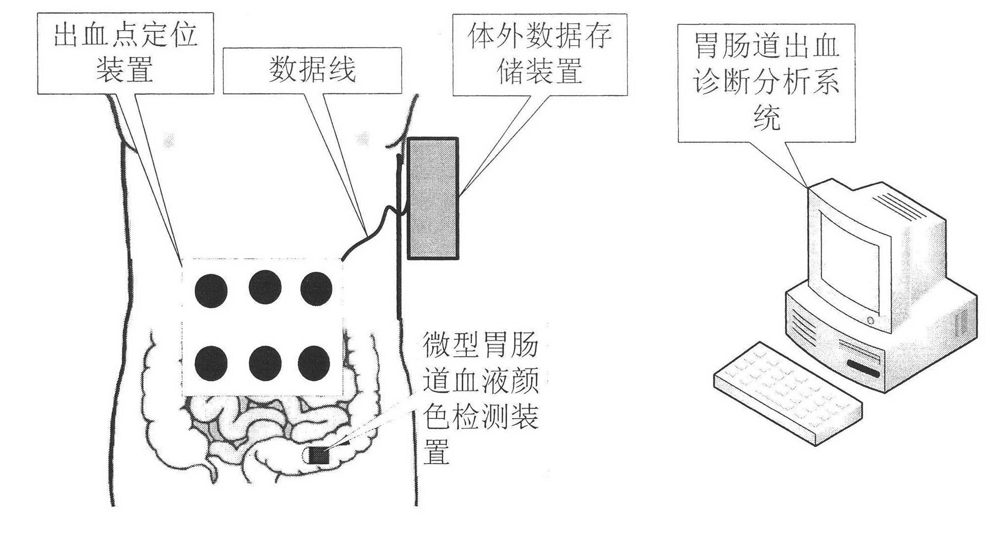 Gastrointestinal Bleeding Intelligent Detection System