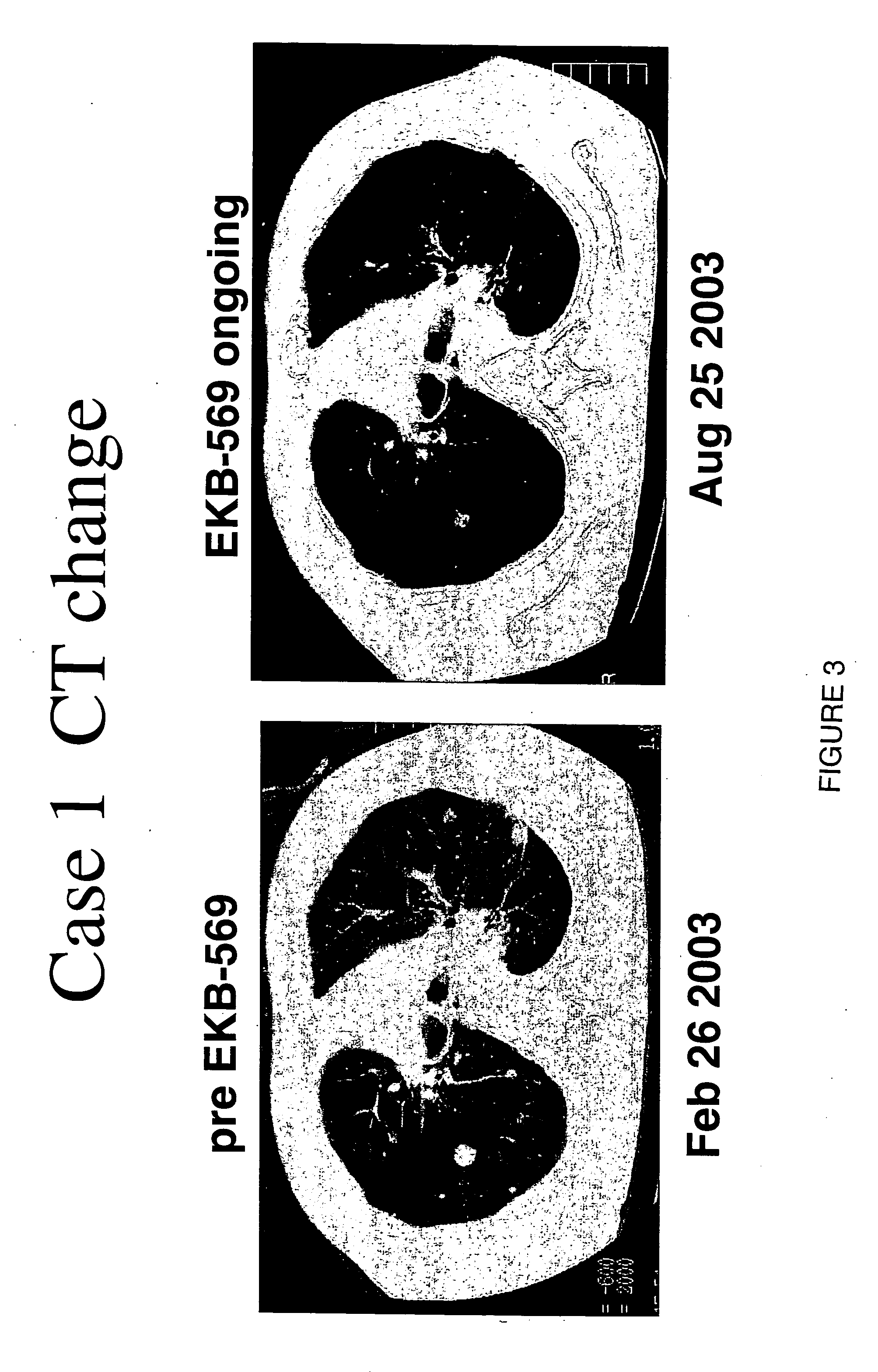 Use of an epidermal growth factor receptor kinase inhibitor (EGFR) in gefitinib resistant patients