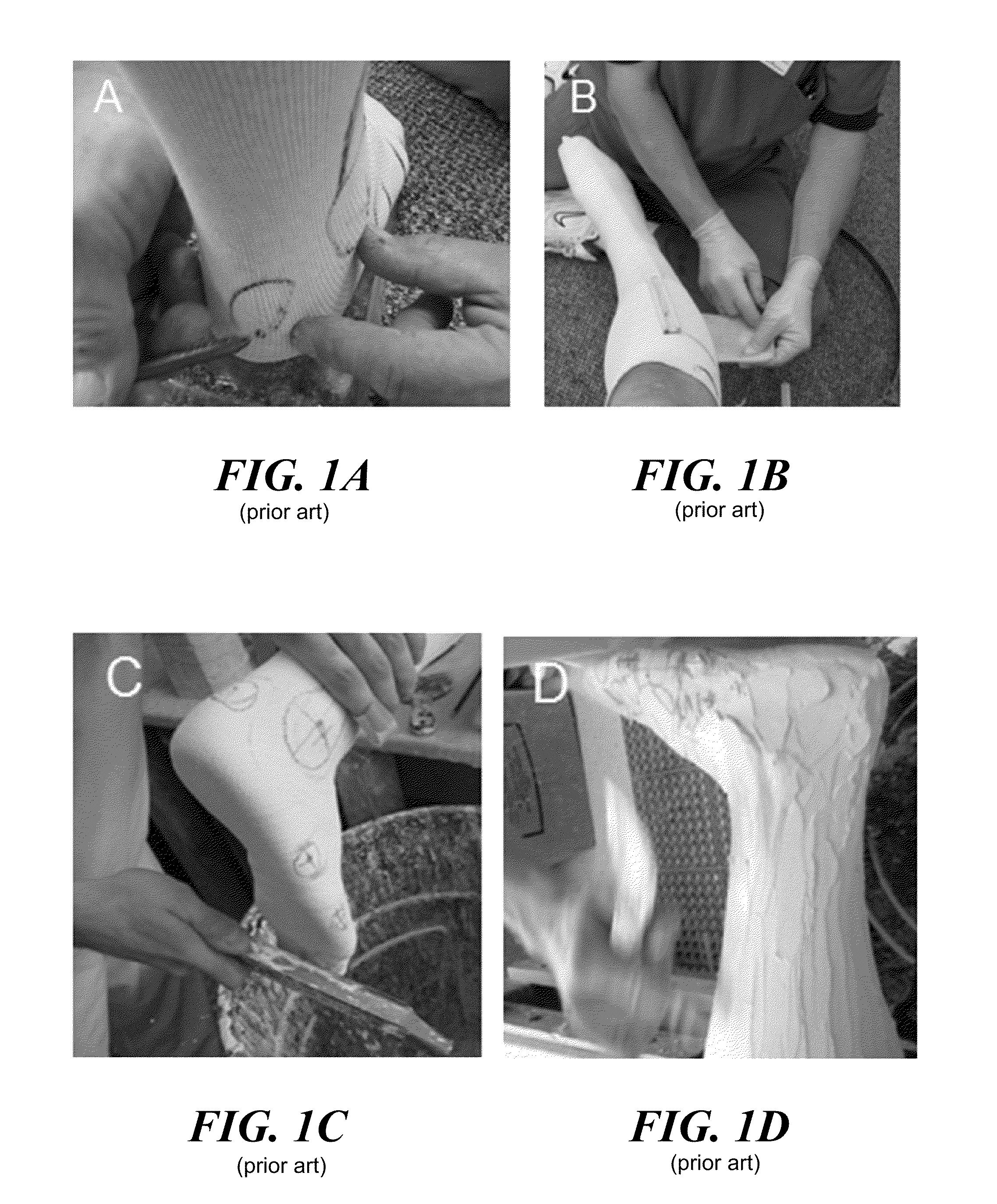 Patient specific ankle-foot orthotic device