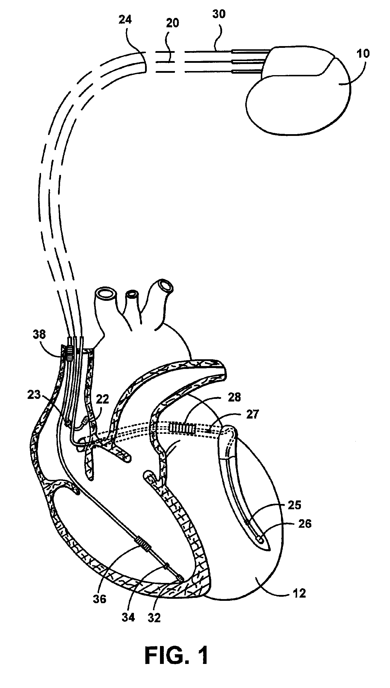 Method and apparatus for automatic capture verification using polarity discrimination of evoked response