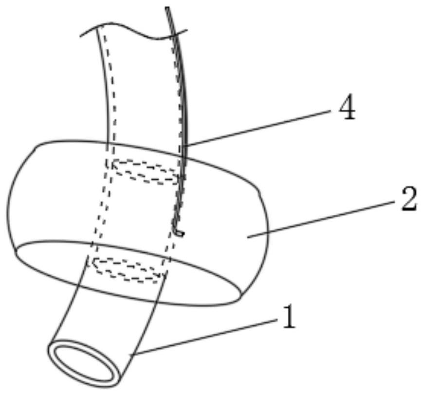 Medical tracheostomy cannula