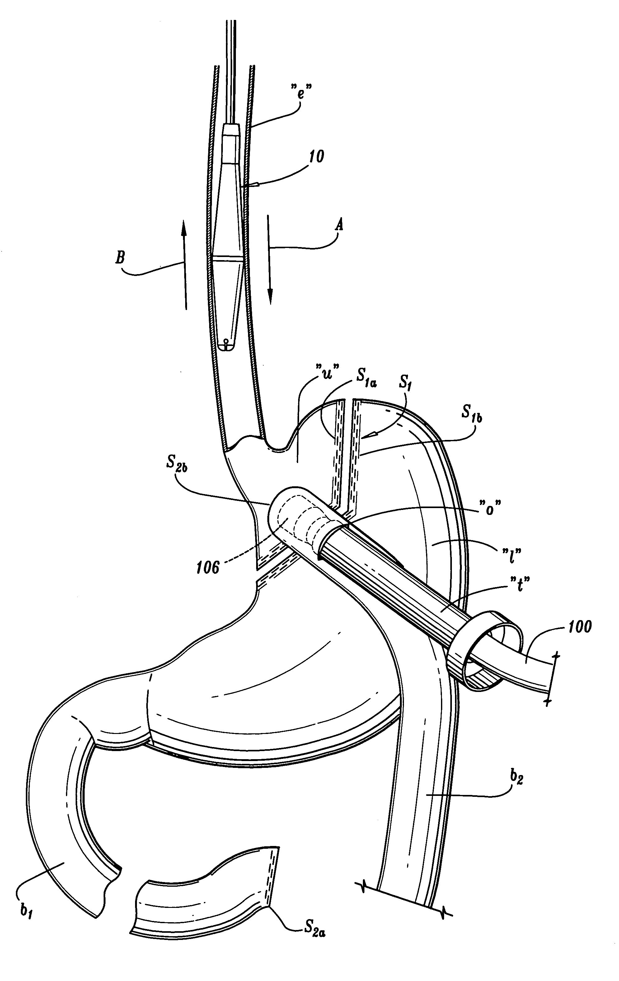 Apparatus and method for performing a bypass procedure in a digestive system