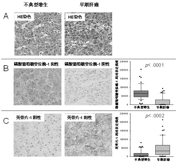 Molecular markers of well-differentiated early liver cancer and use thereof