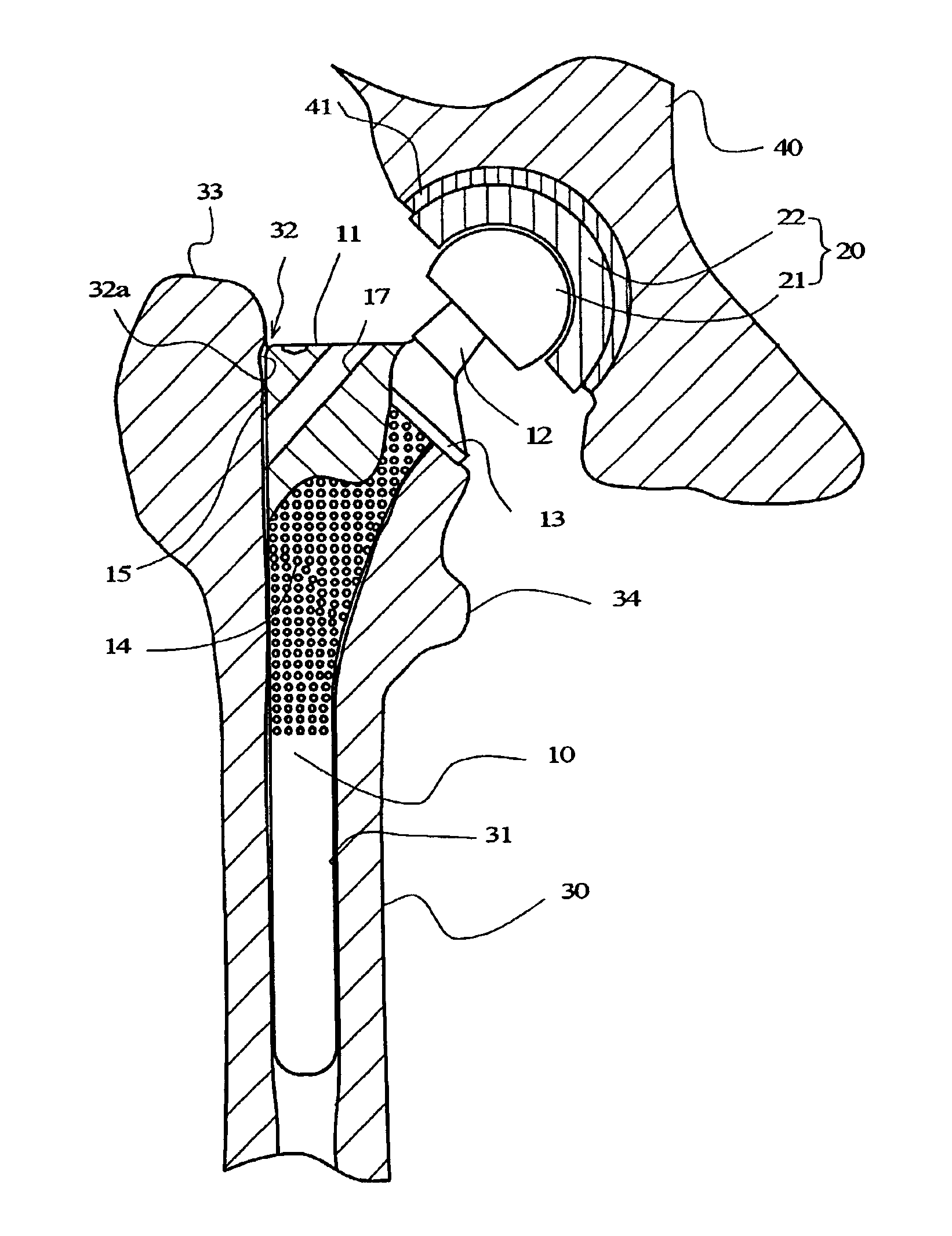 Stem of artificial hip joint