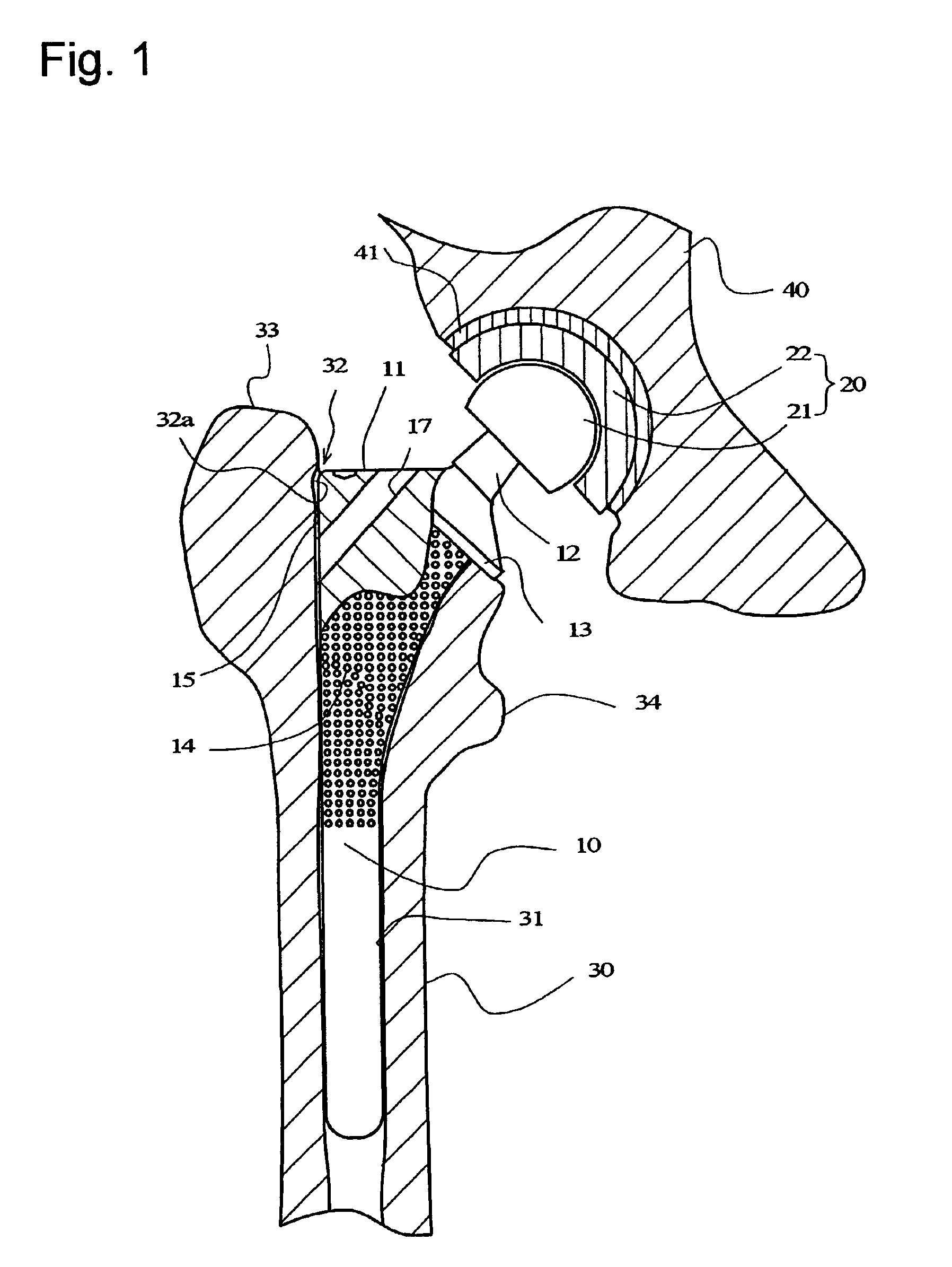 Stem of artificial hip joint