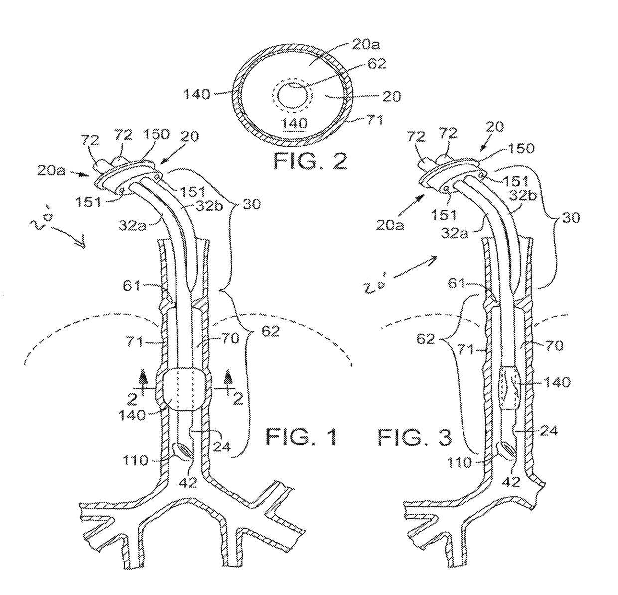 Secretion clearing patient airway management system