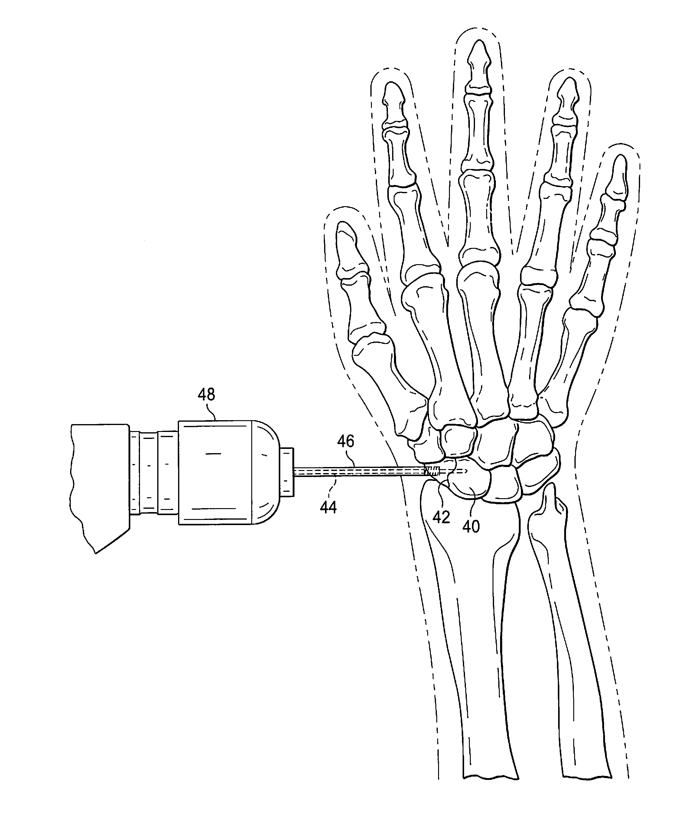 Percutaneous exchange tube and method of use