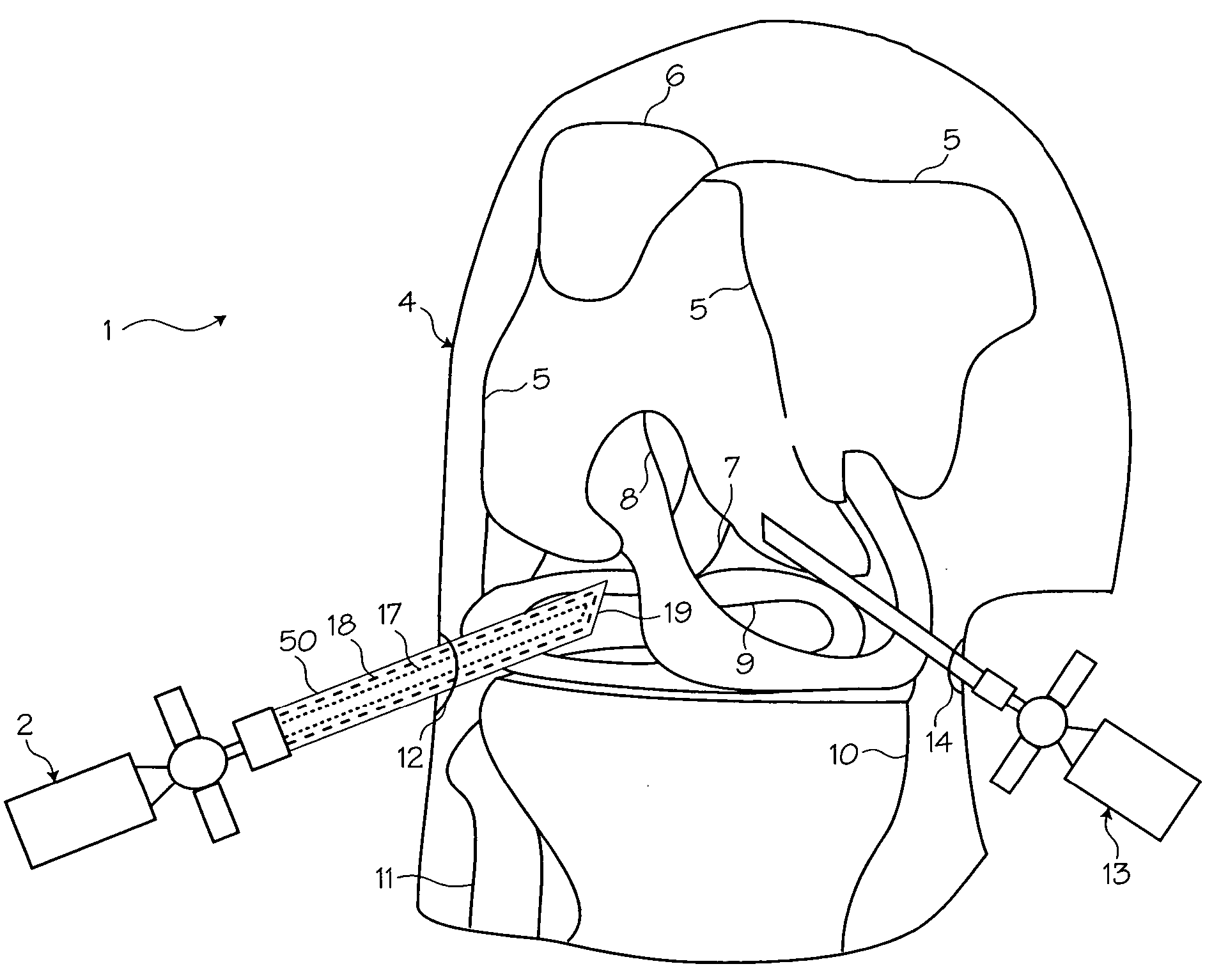 Atraumatic arthroscopic instrument sheath