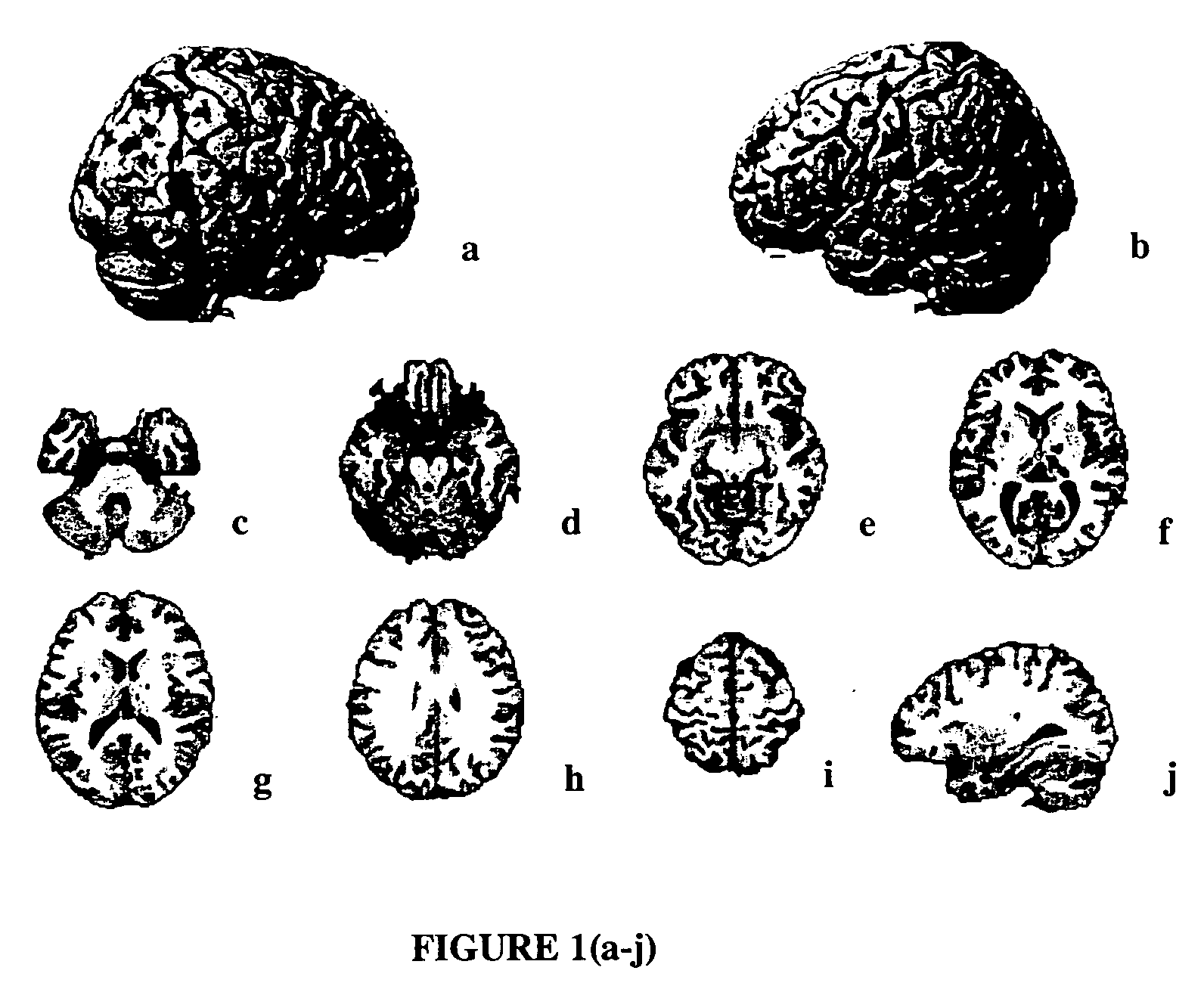 Memantine for the treatment of mild and mild to moderate Alzheimer's disease