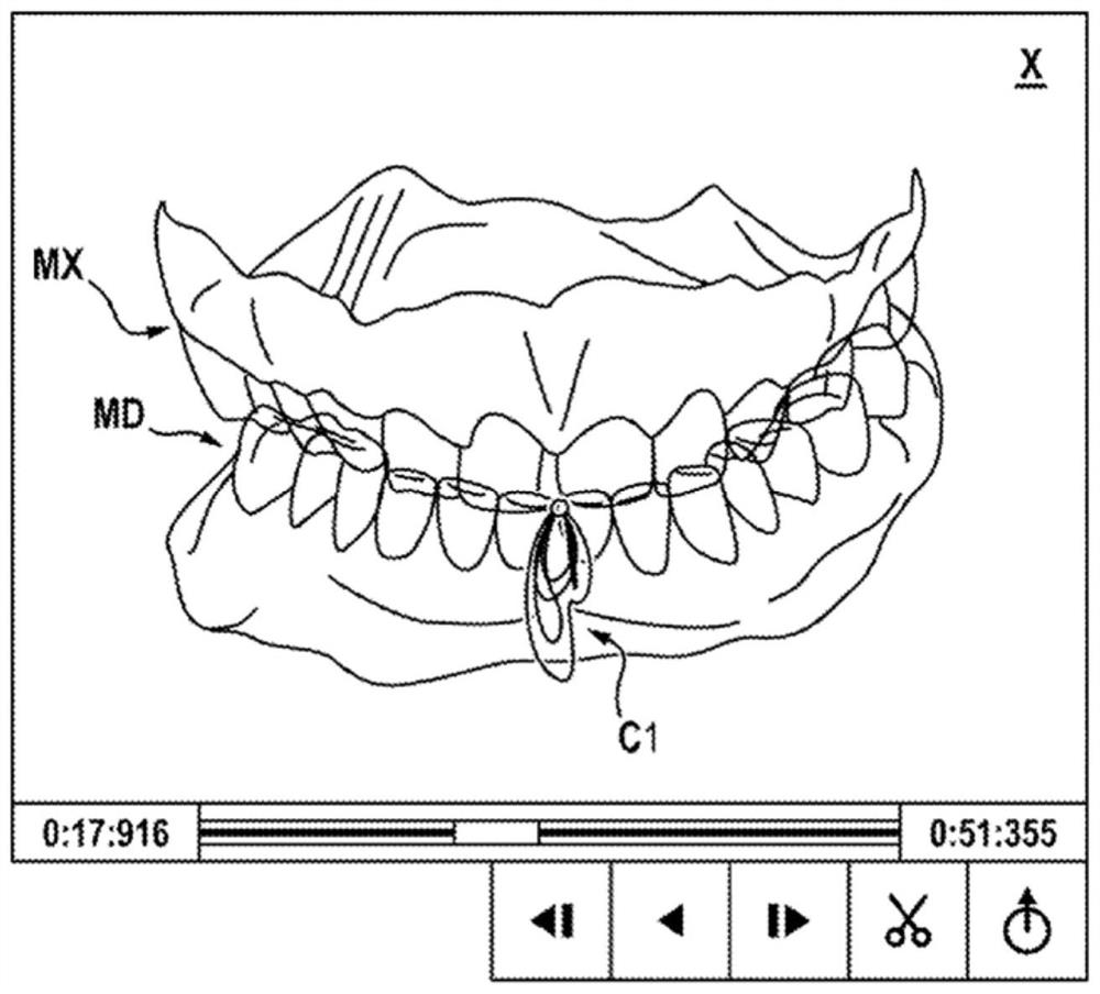 Method for animating models of the mandibular and maxillary arches of a patient in a corrected intermaxillary relationship