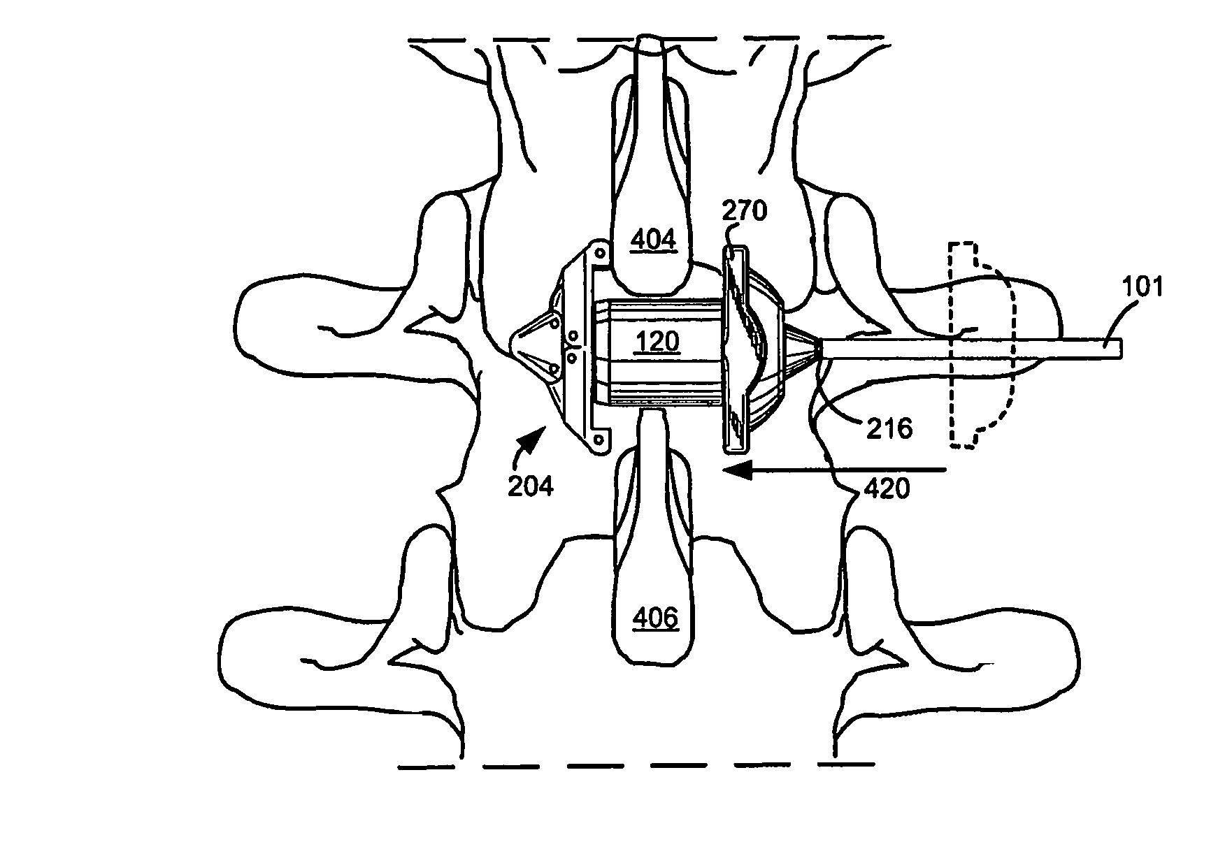 Systems and methods for in situ assembly of an interspinous process distraction implant