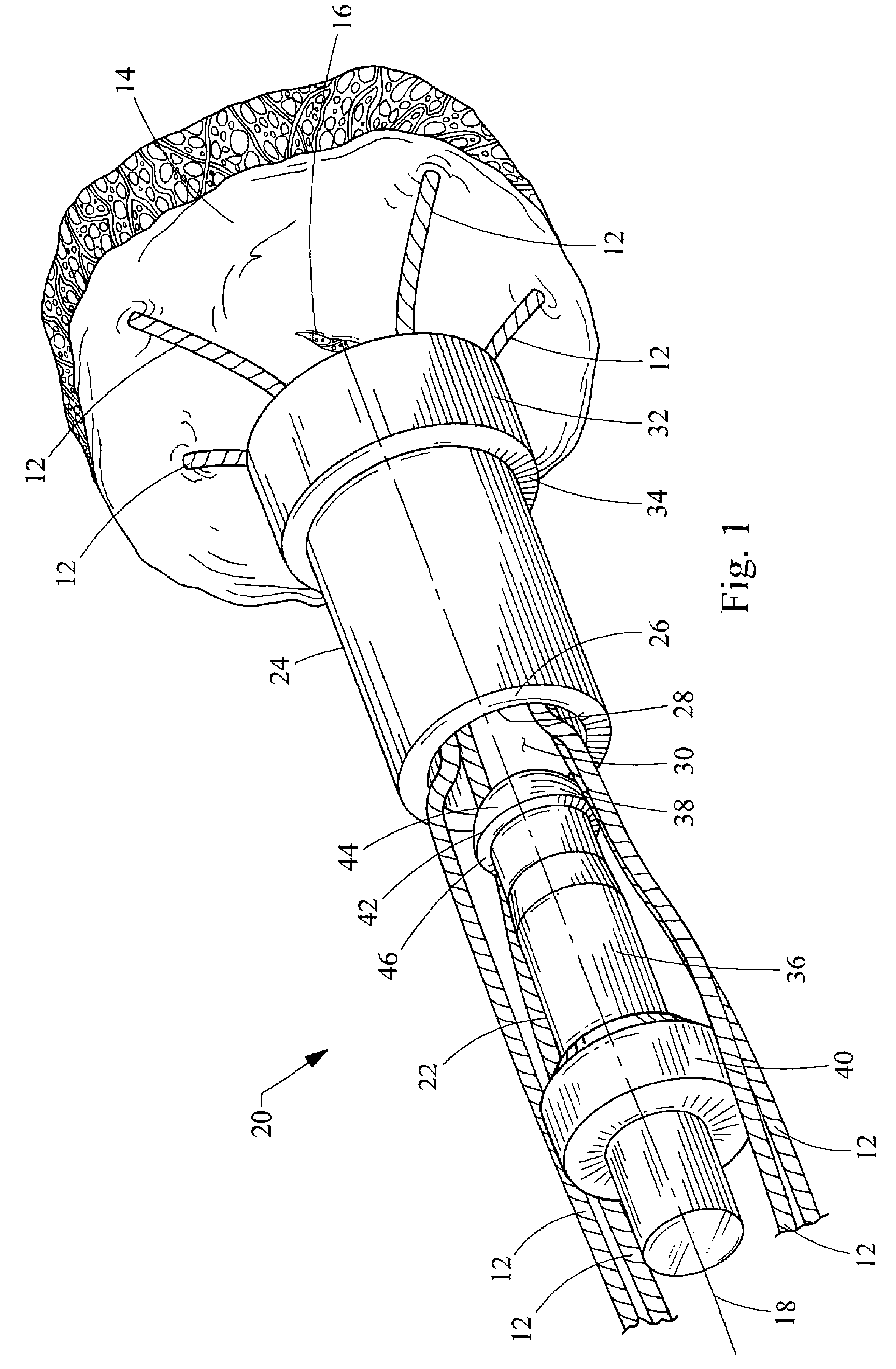 Suture lock