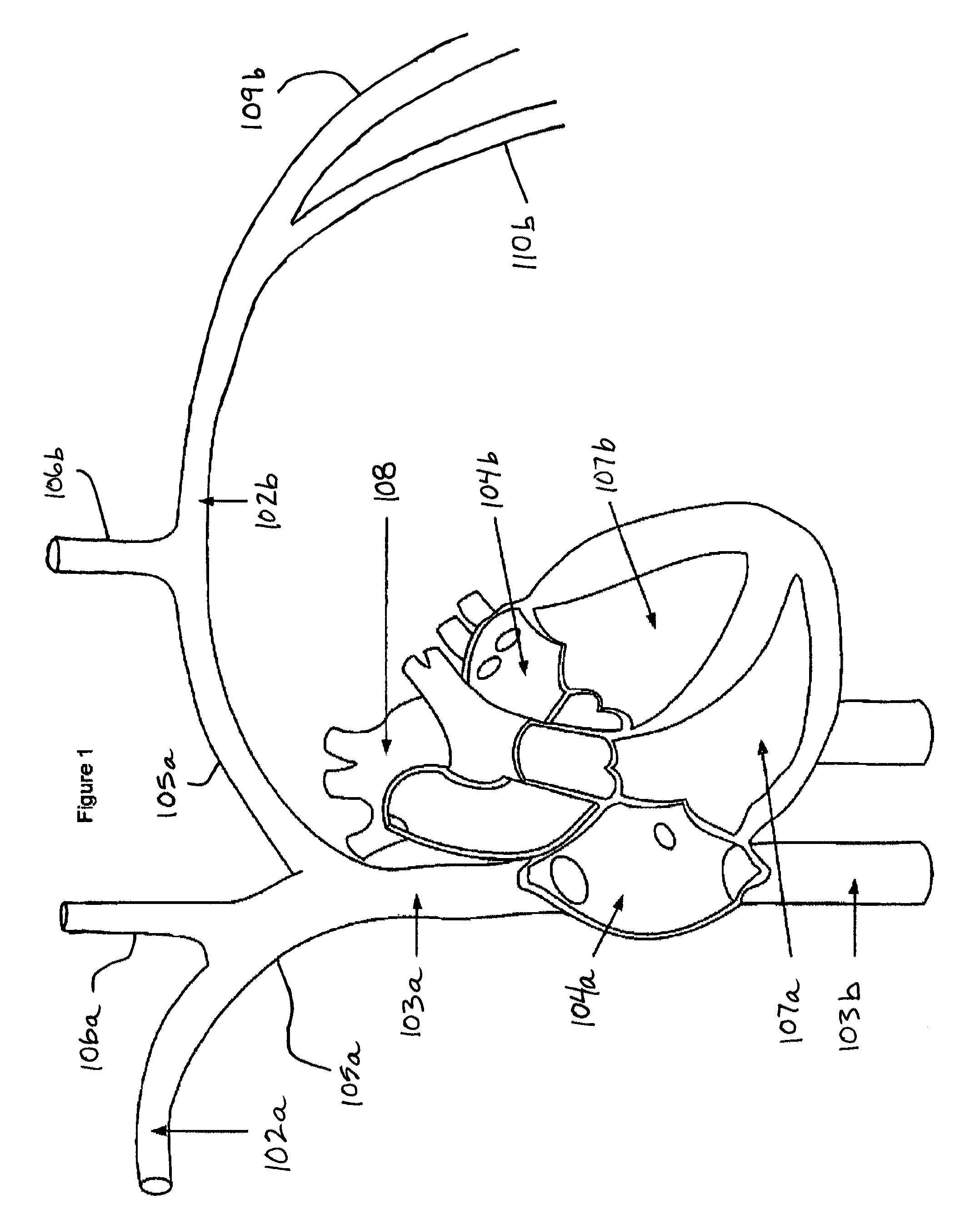 Intravascular implantable device having superior anchoring arrangement