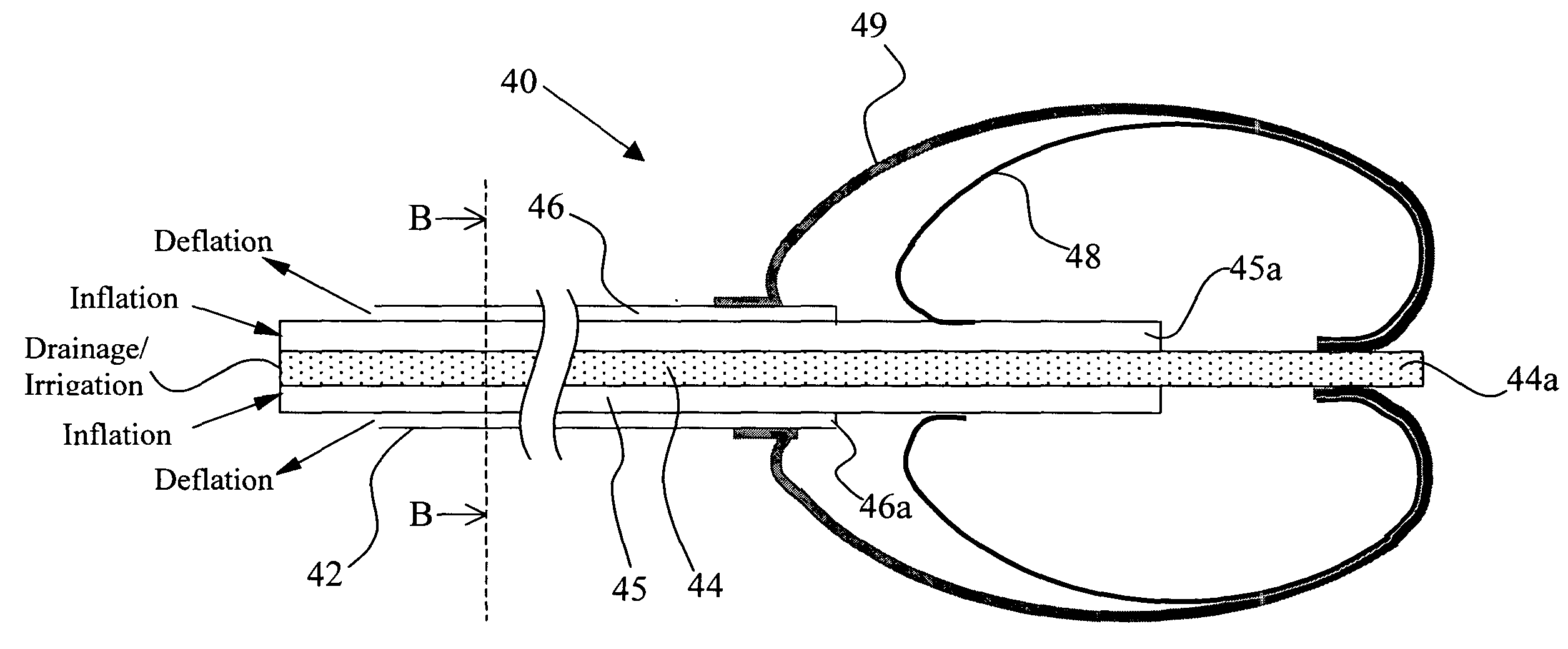 Inflatable dual balloon catheter