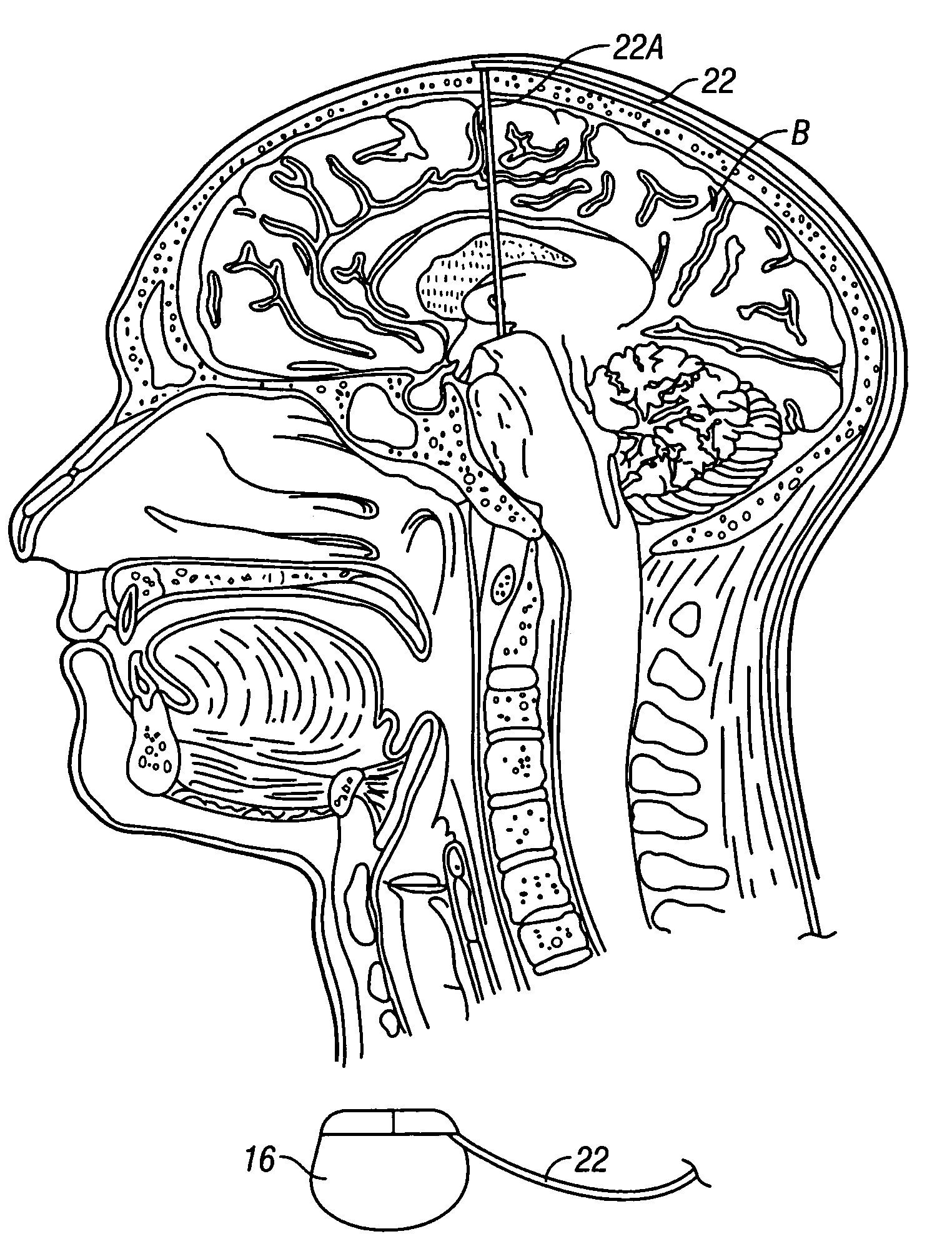 System and method of treating stuttering by neuromodulation