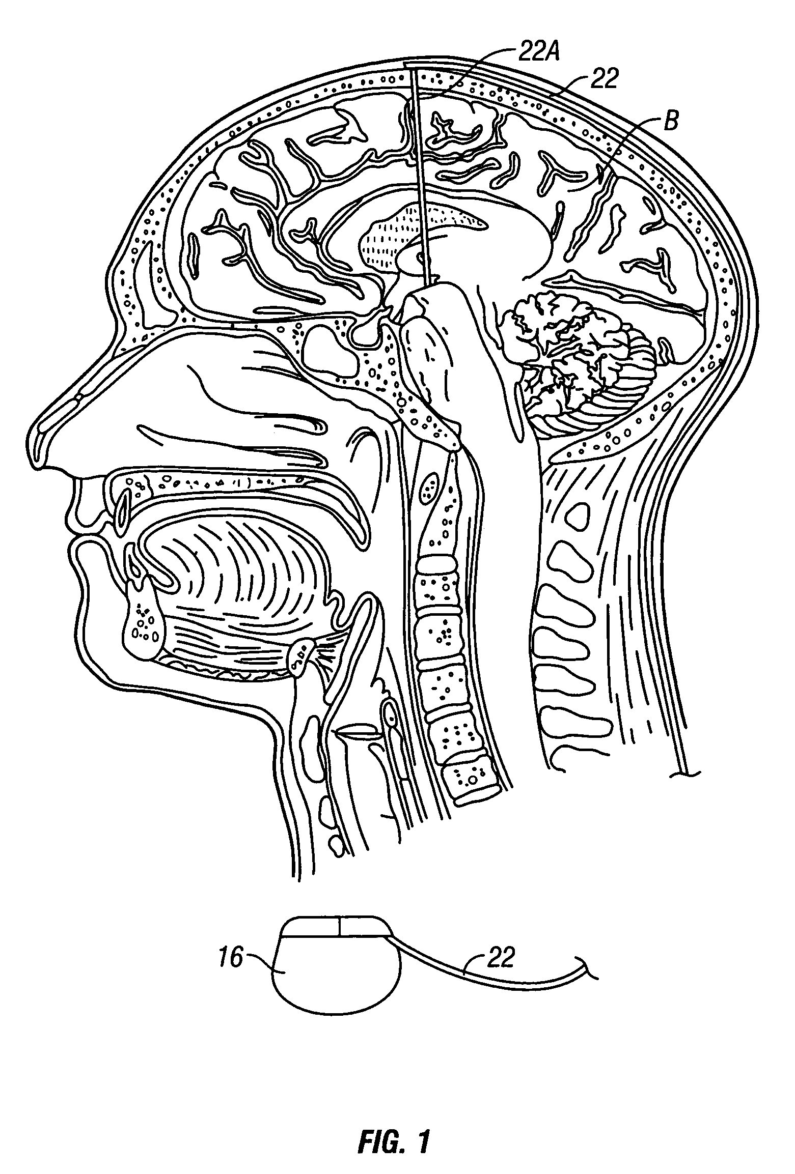 System and method of treating stuttering by neuromodulation