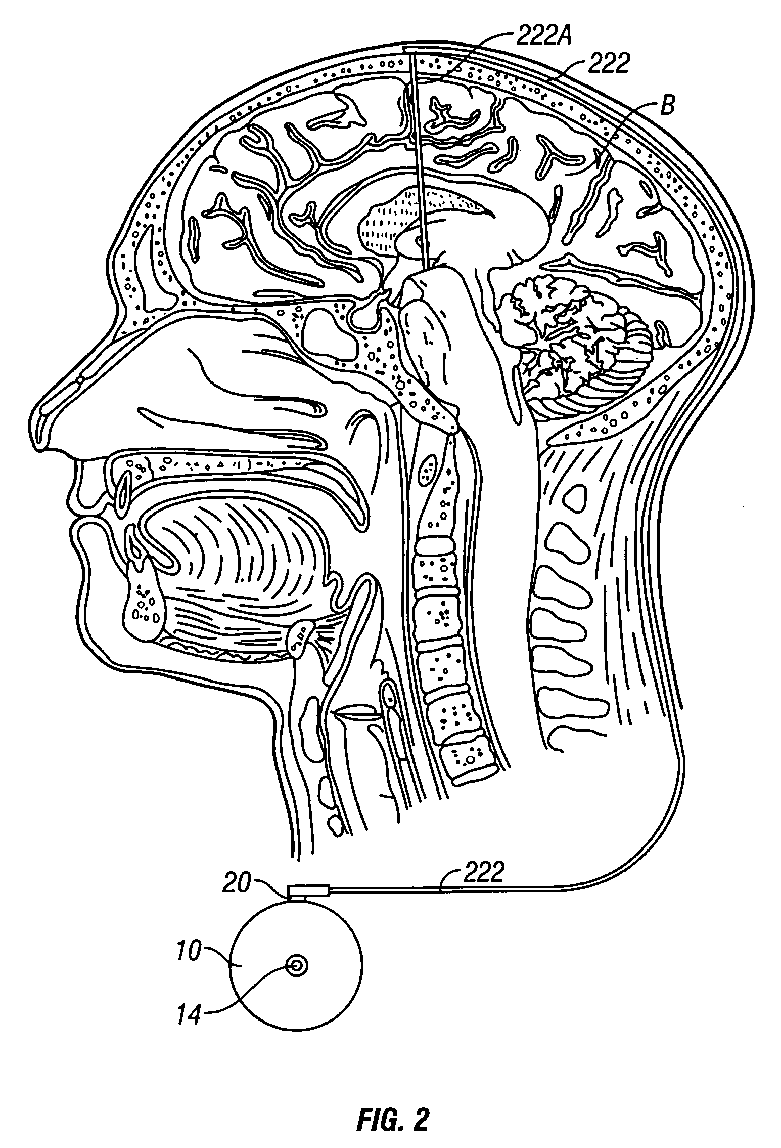 System and method of treating stuttering by neuromodulation