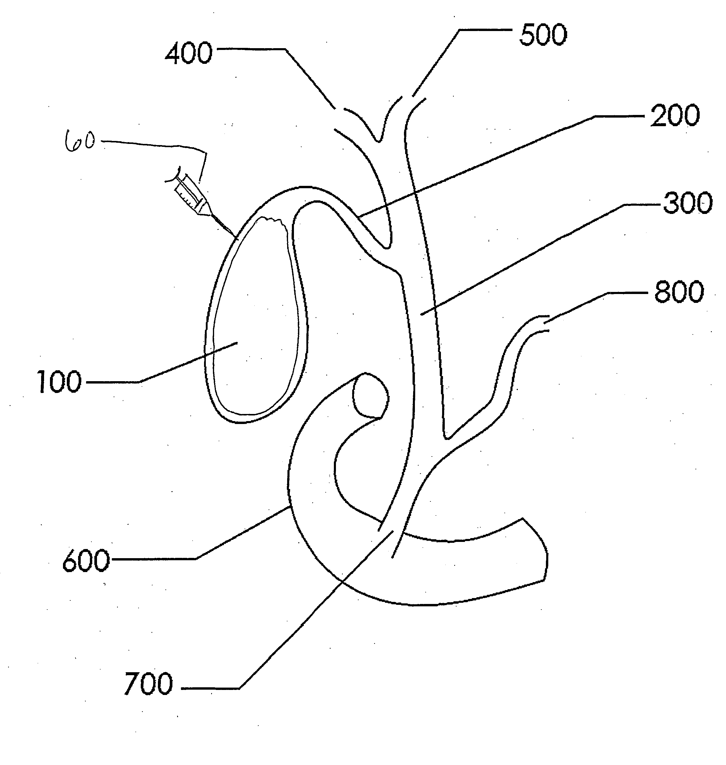 Methods and devices for treating obesity