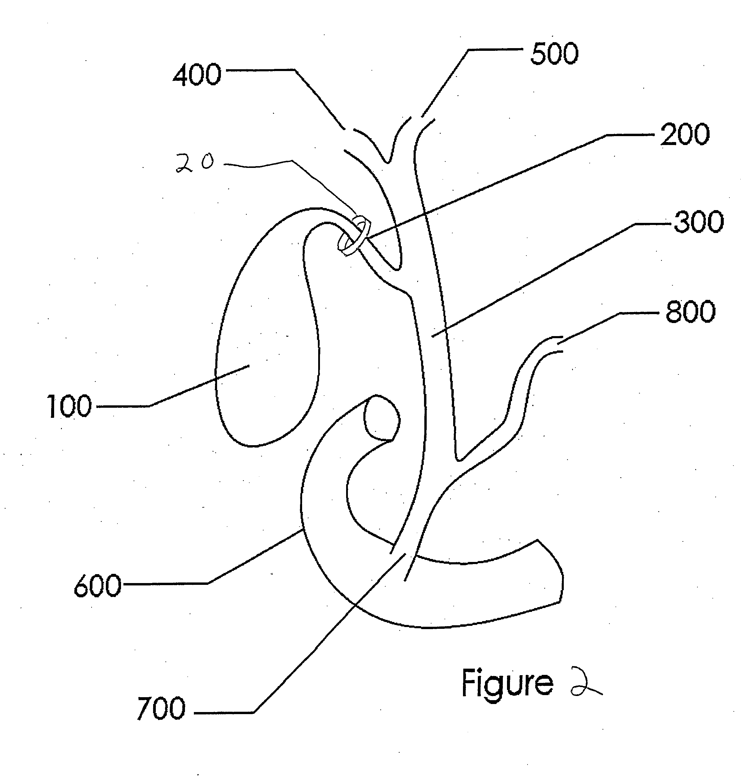 Methods and devices for treating obesity