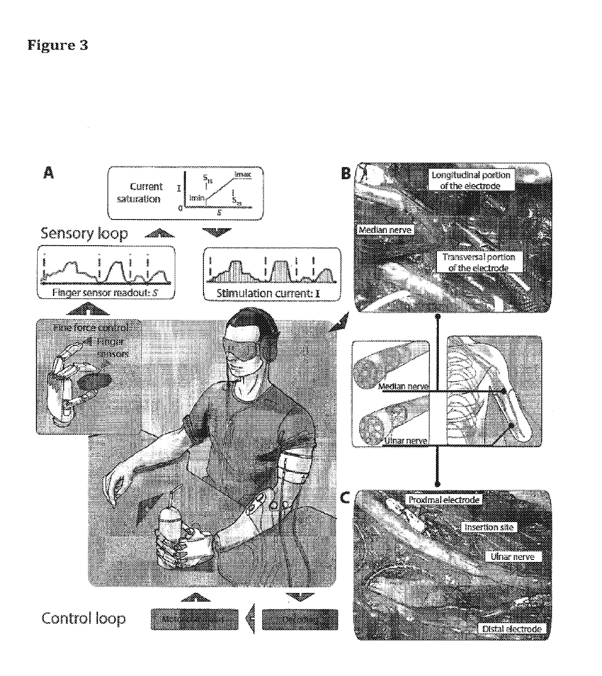 Bidirectional limb neuro-prosthesis