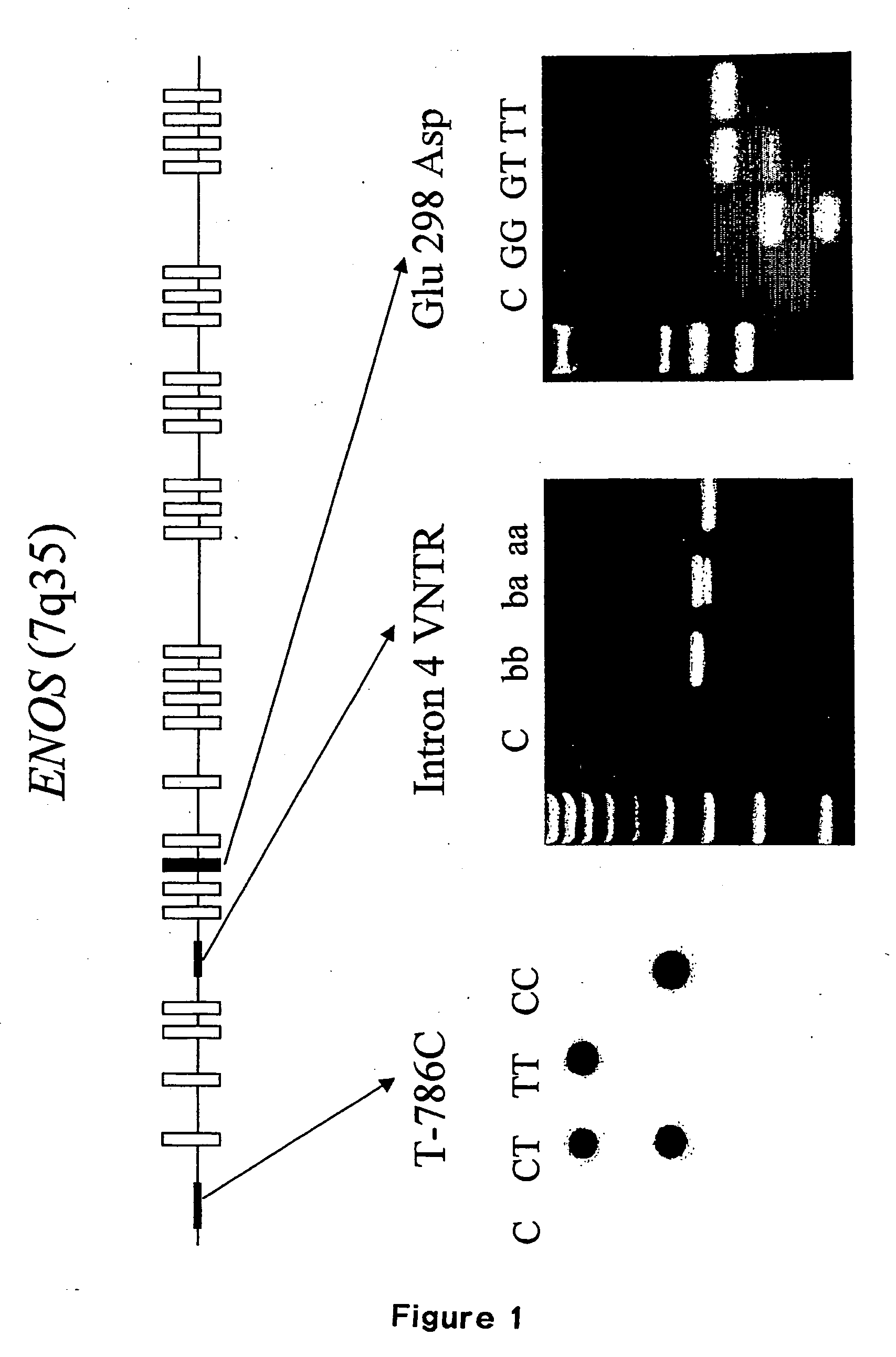 Method for diagnosing and treating predisposition for accelerated autosomal dominant polycystic kidney disease