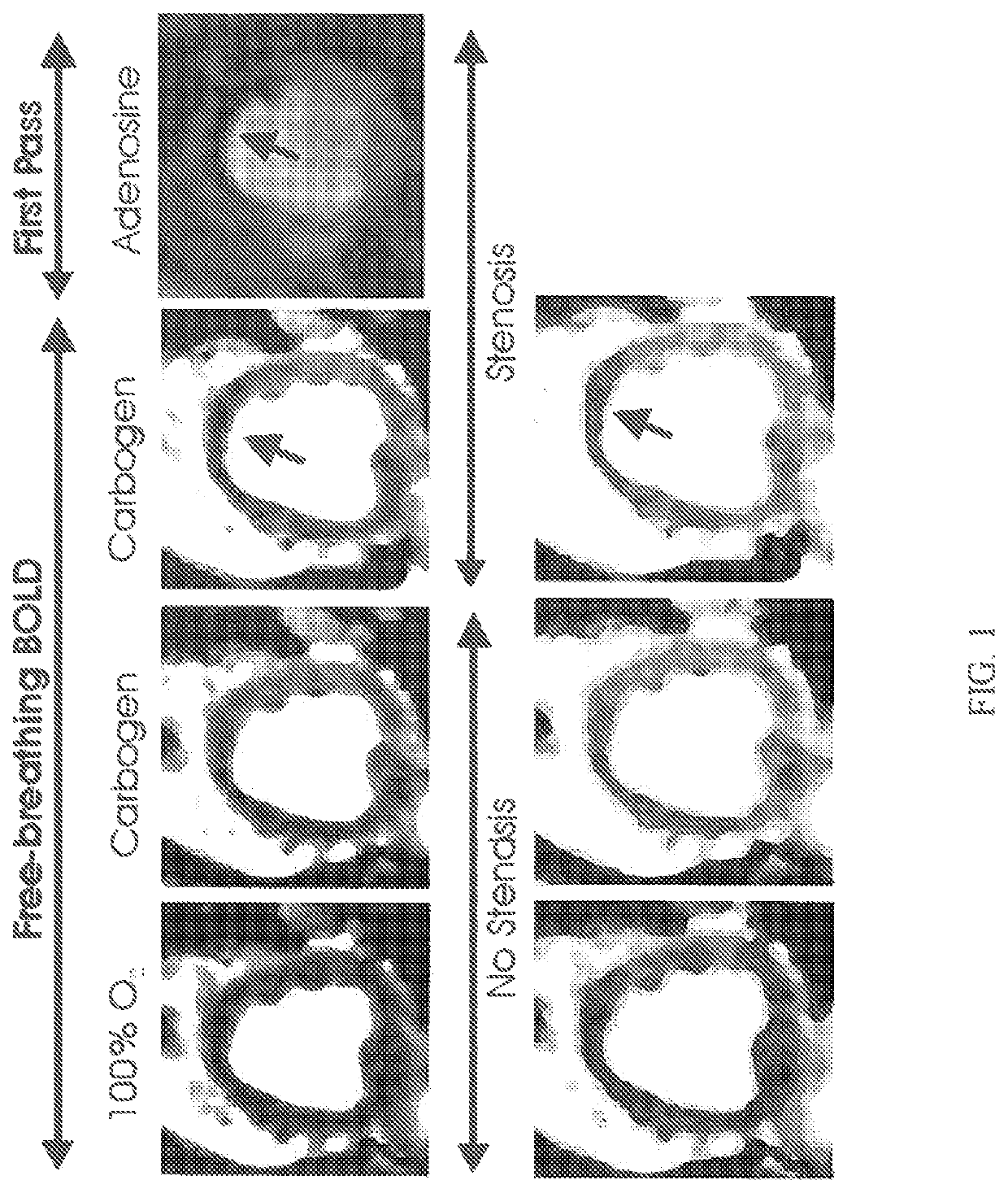 Assessment of coronary heart disease with carbon dioxide