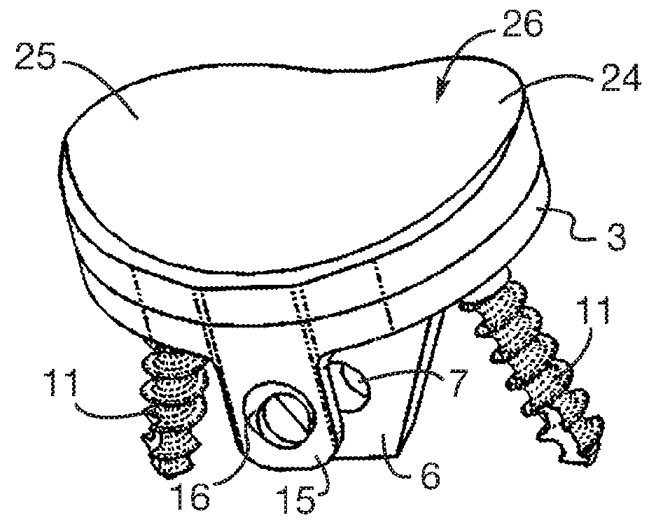 Glenoid cavity bone preparation set for setting a shoulder prosthesis, and method for implanting a shoulder prosthesis